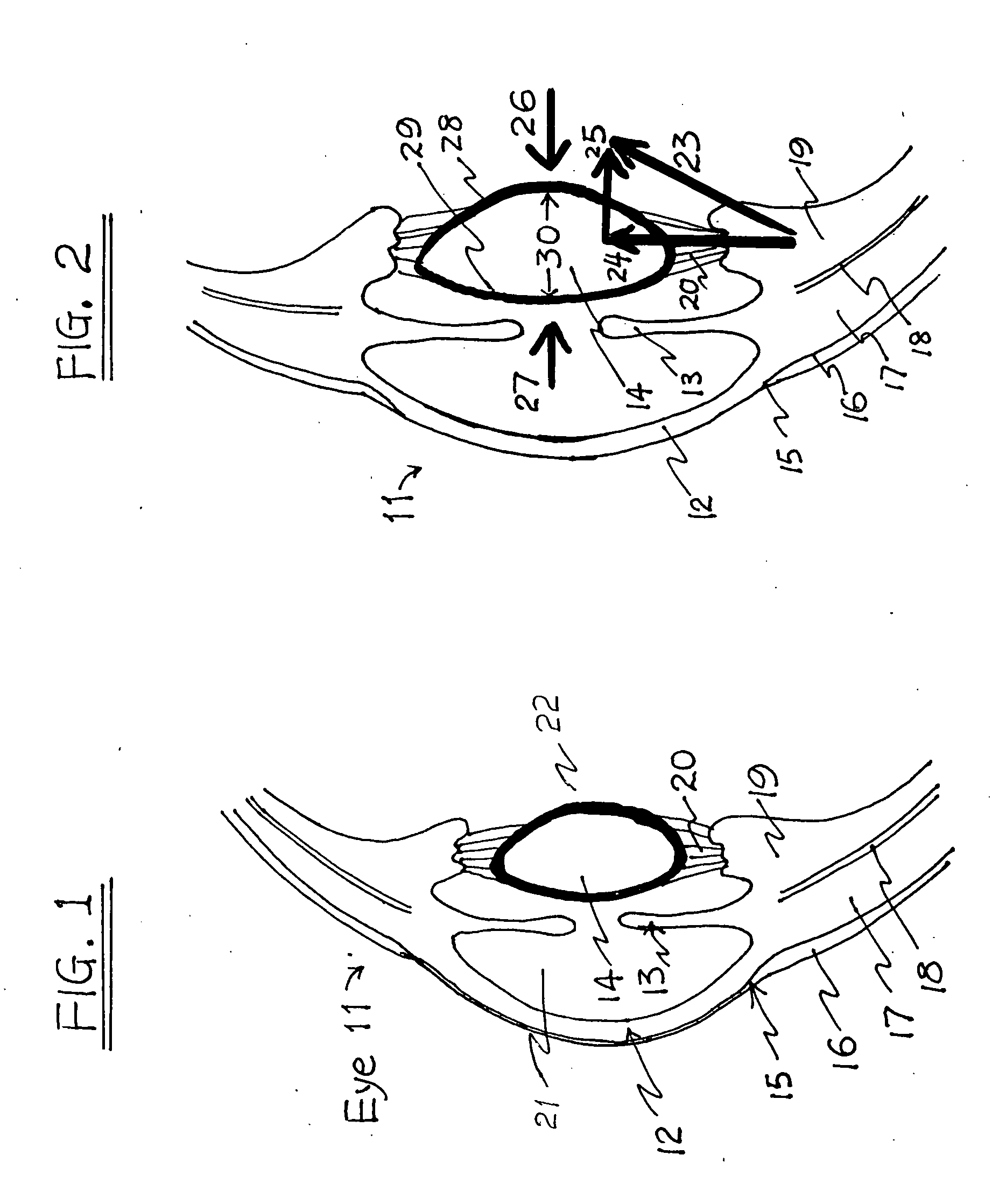 Method and apparatus for the treatment of presbyopia and glaucoma by ciliary body ablation