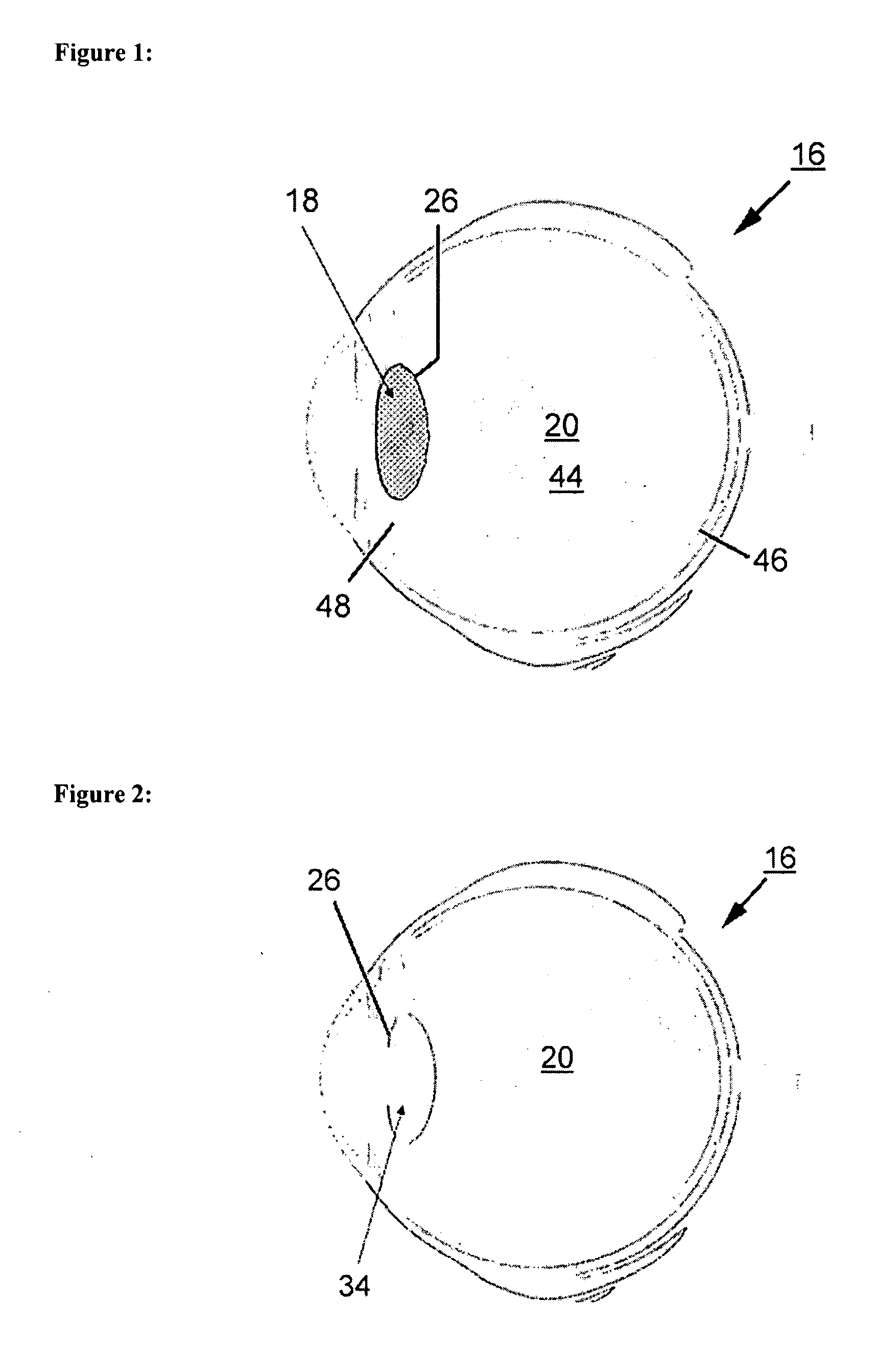 Eye implant and methods of positioning an artificial eye implant within the eye of a human or an animal
