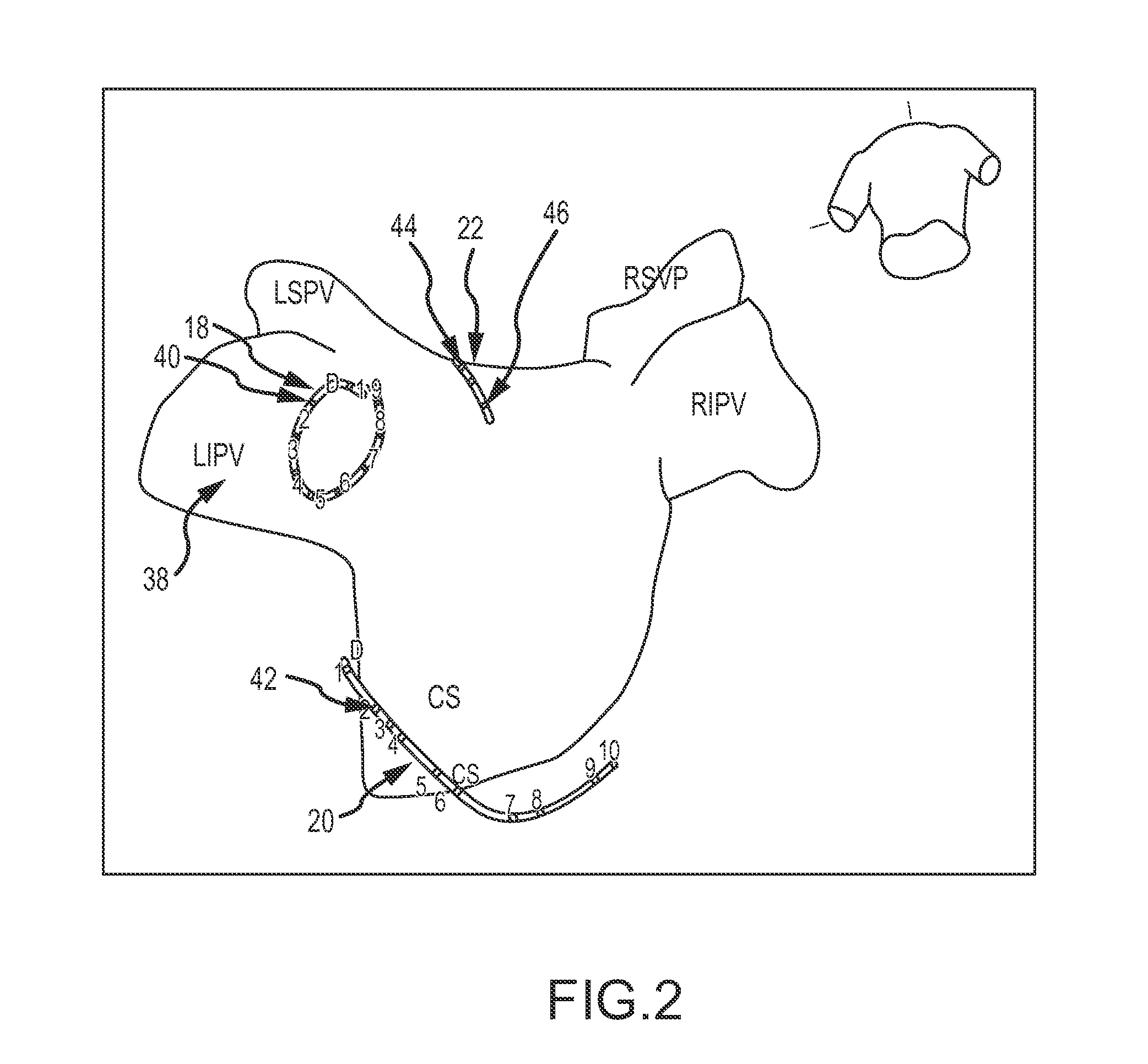 System and method for treating arrhythmias in the heart using information obtained from heart wall motion