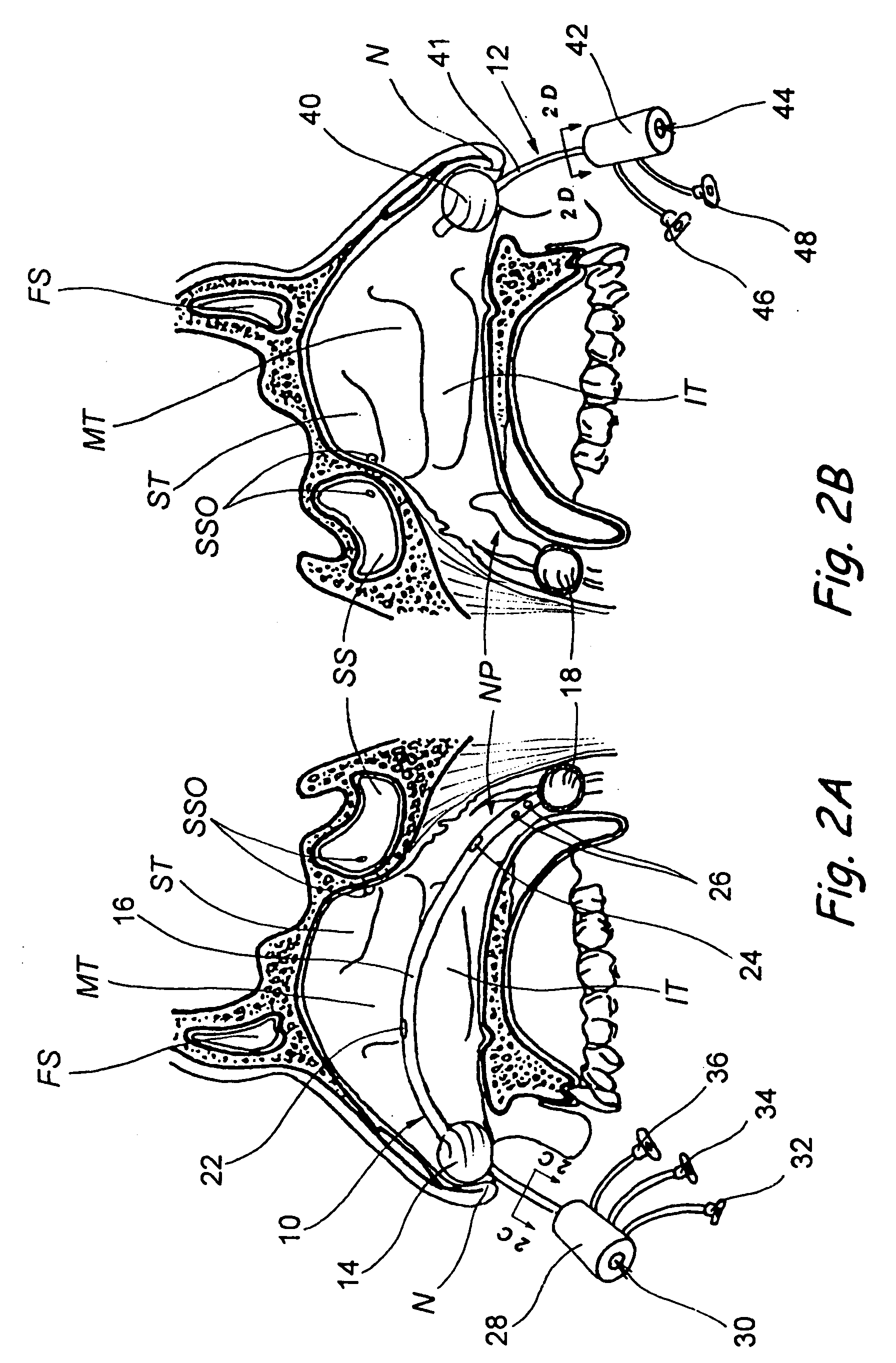 Devices, systems and methods for diagnosing and treating sinusitus and other disorders of the ears, nose and/or throat