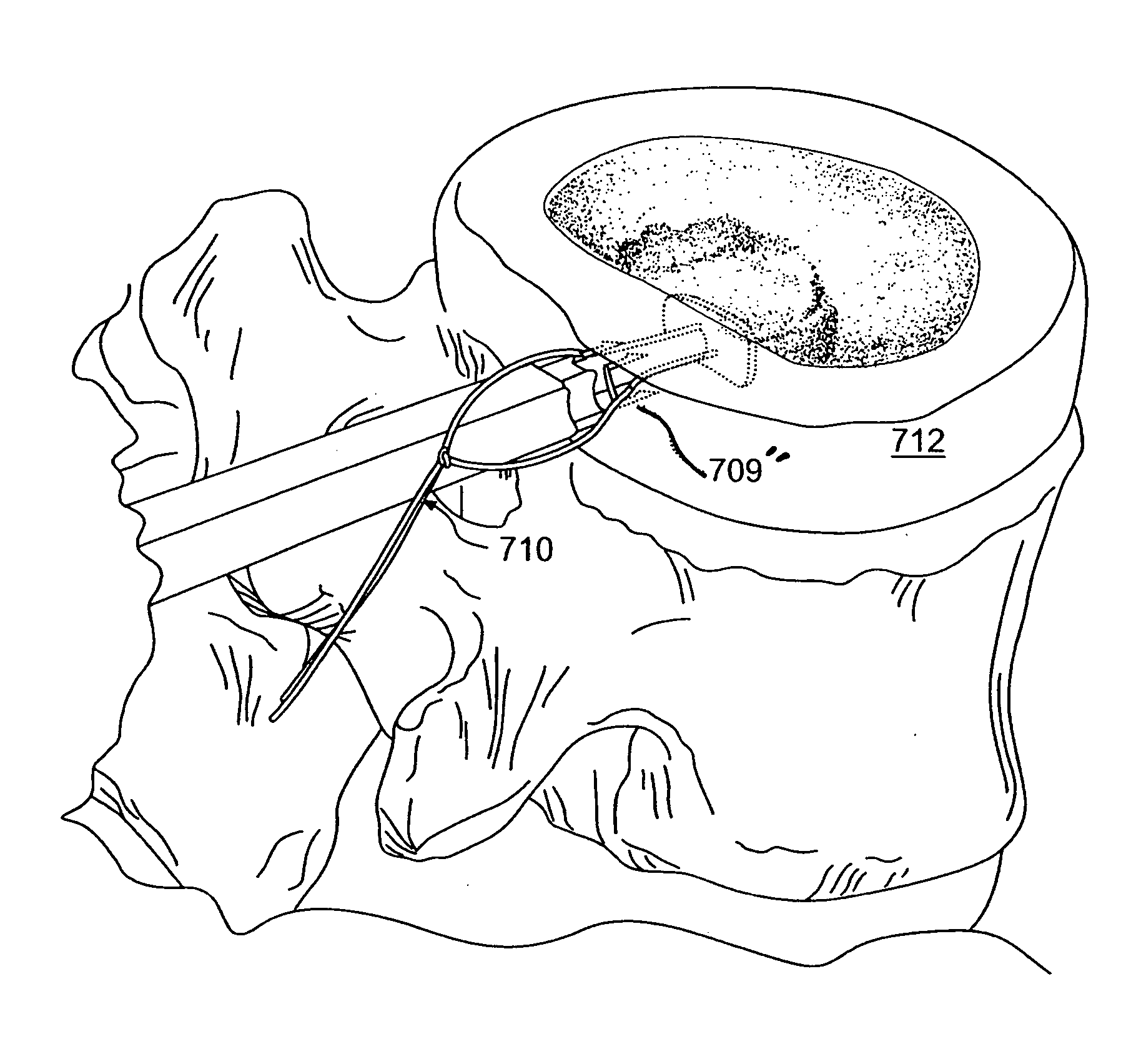 Apparatus and methods for the treatment of the intervertebral disc