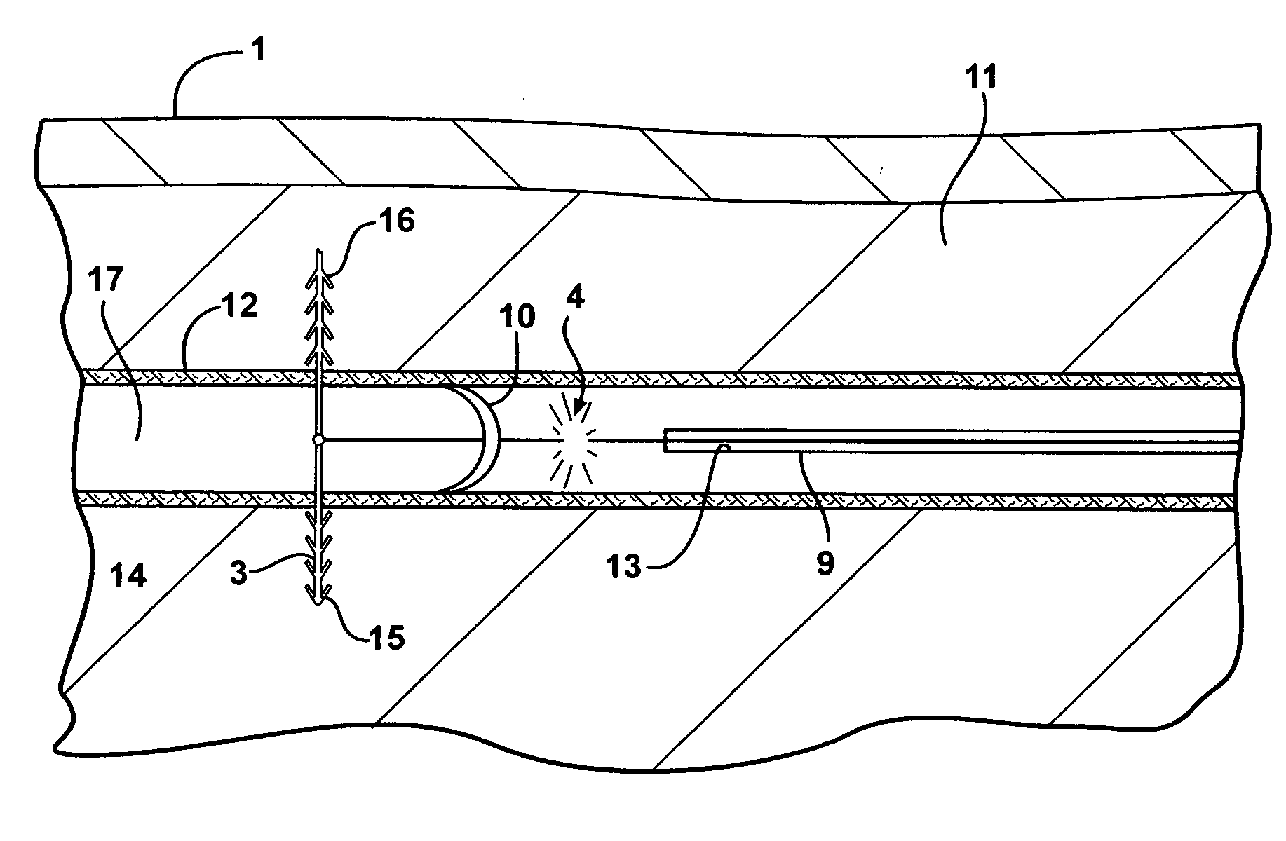 Methods and apparatus for utilization of barbed sutures in human tissue including a method for eliminating or improving blood flow in veins