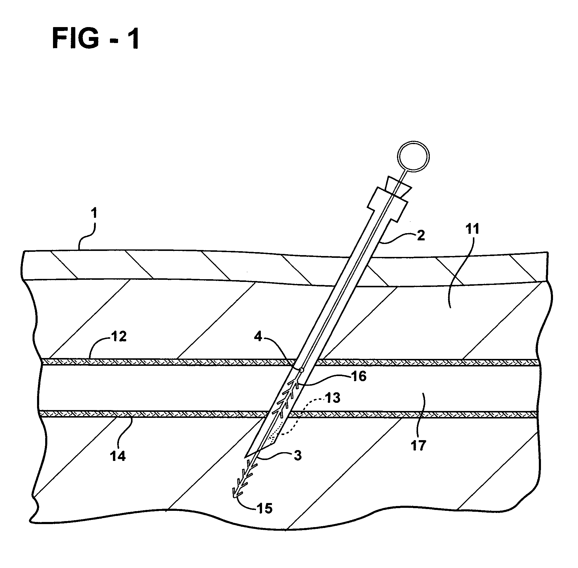Methods and apparatus for utilization of barbed sutures in human tissue including a method for eliminating or improving blood flow in veins