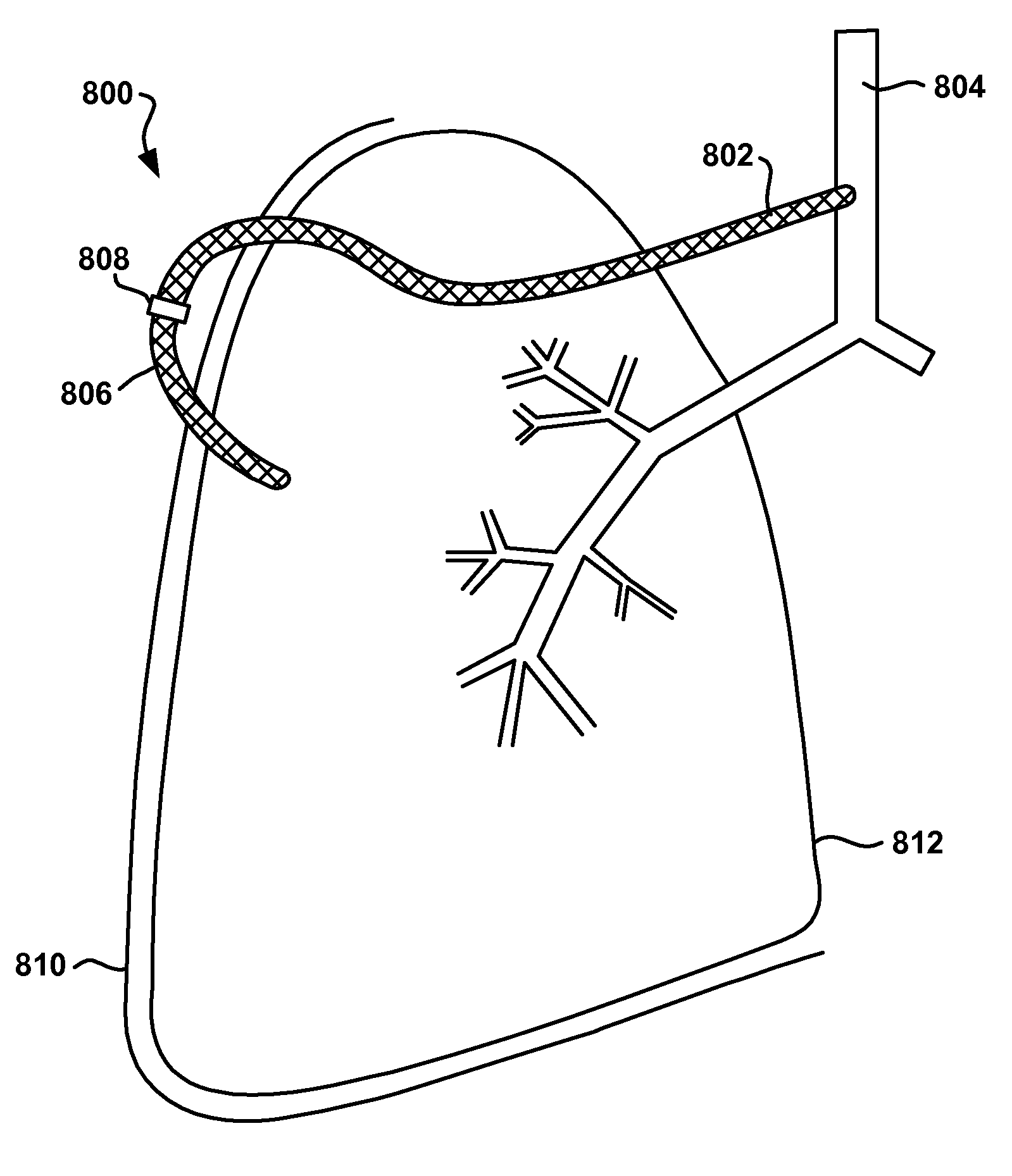 Intra/extra thoracic system for ameliorating a symptom of chronic obstructive pulmonary disease