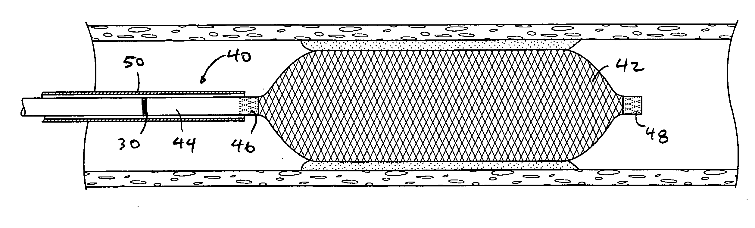 Devices and methods for temporarily opening a blood vessel