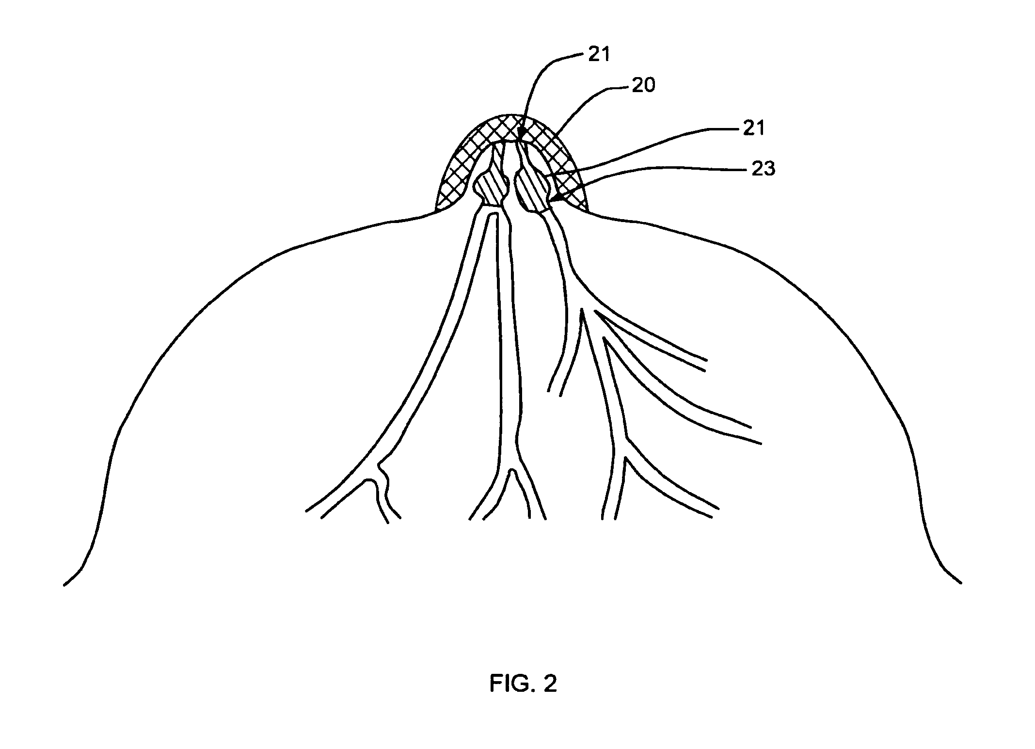 Methods and devices for delivery of agents to breast milk ducts