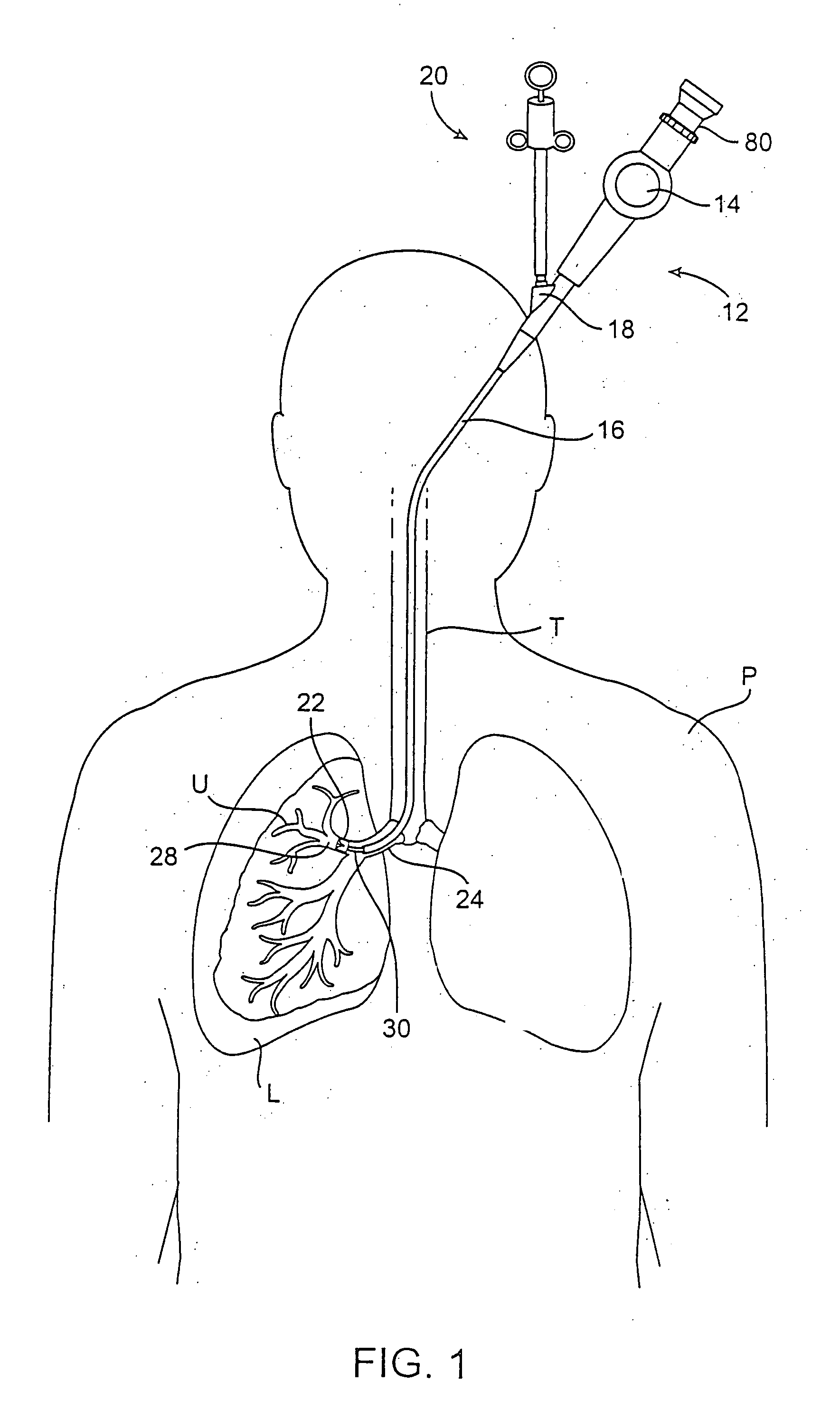 Methods and devices for use in performing pulmonary procedures