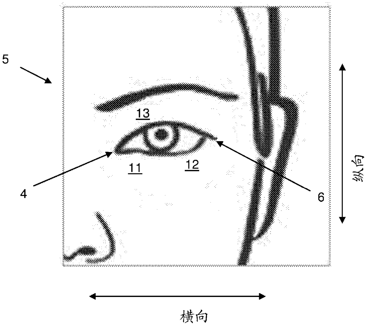 Method of improving the appearance of periorbital dyschromia