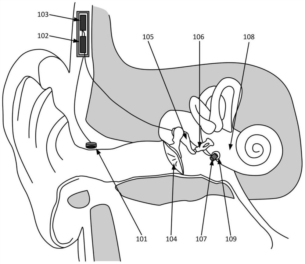 A fixed bracket for a circular window-excited vibration type artificial middle ear actuator