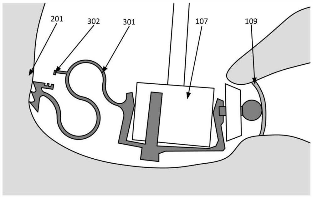 A fixed bracket for a circular window-excited vibration type artificial middle ear actuator