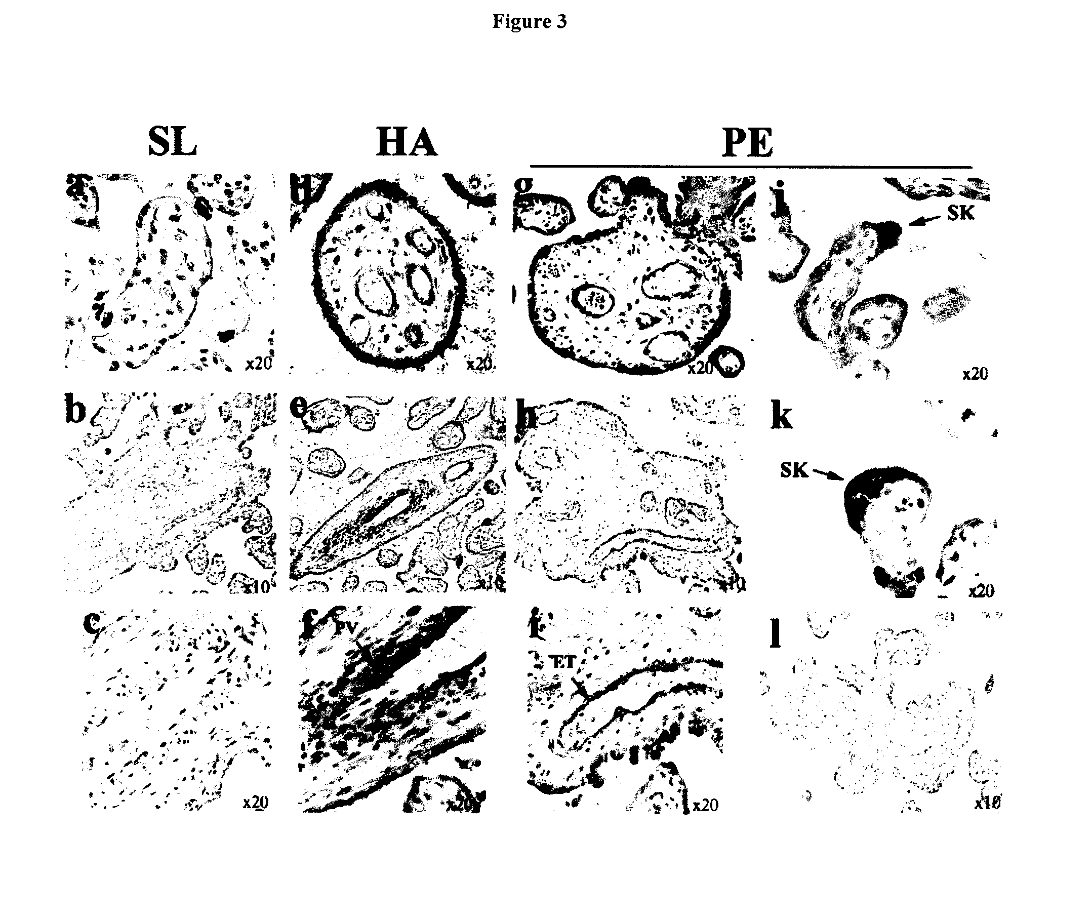 Diagnostic compositions and treatment methods for conditions involving trophoblast cell death, differentiation, invasion and/or cell fusion and turnover