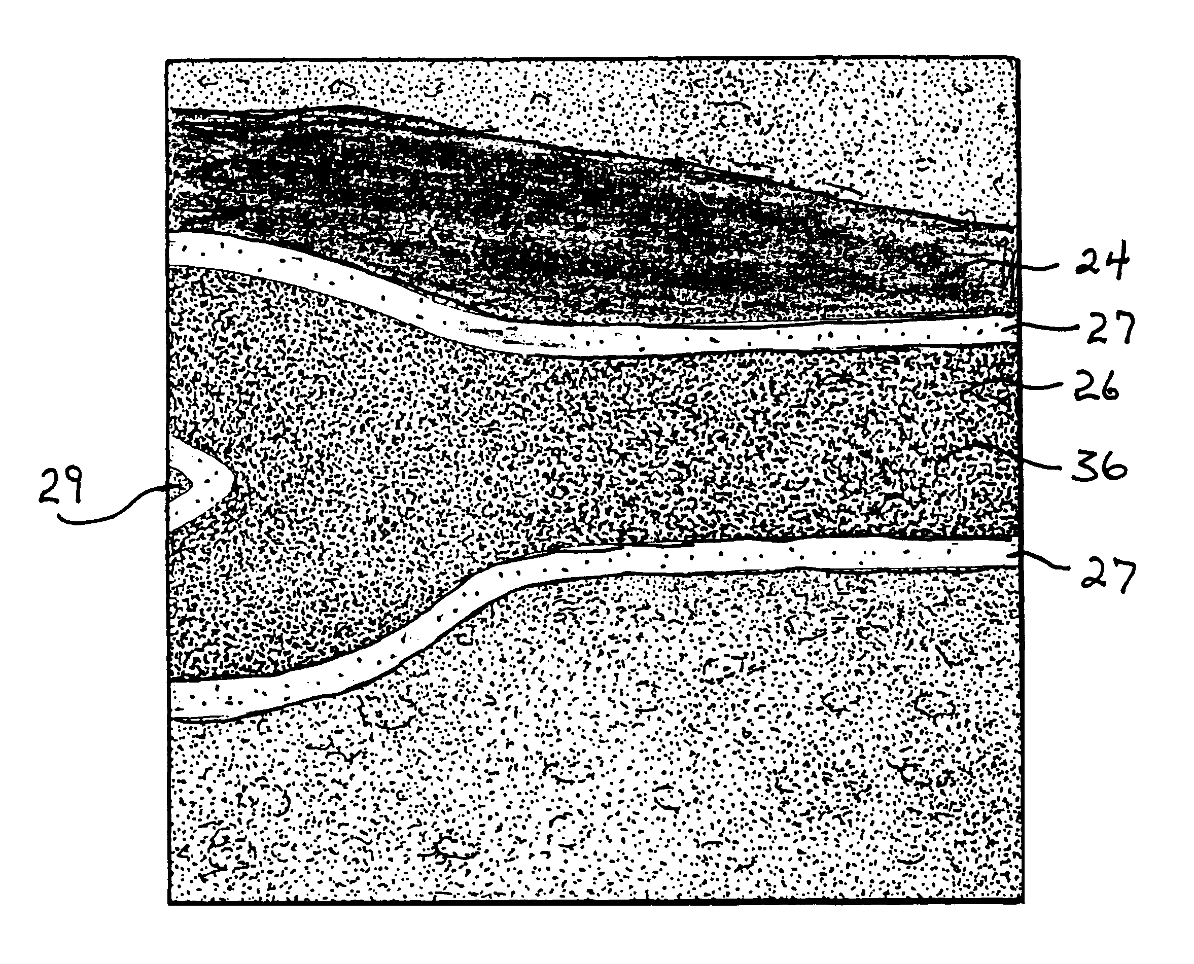 Split-screen display system and standardized methods for ultrasound image acquisition and processing for improved measurements of vascular structures