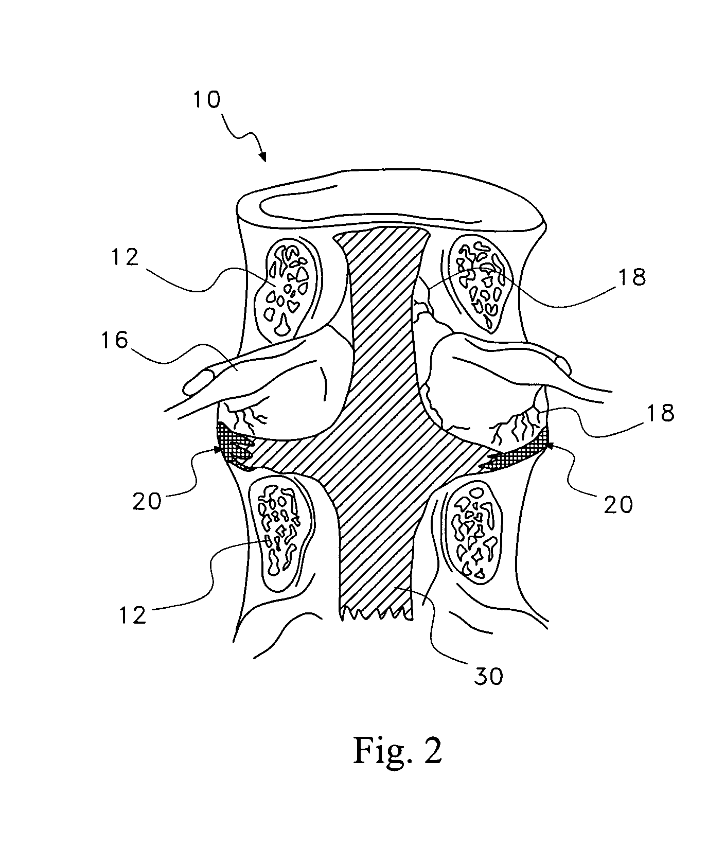 Pharmaceutical removal of vascular extensions from a degenerating disc