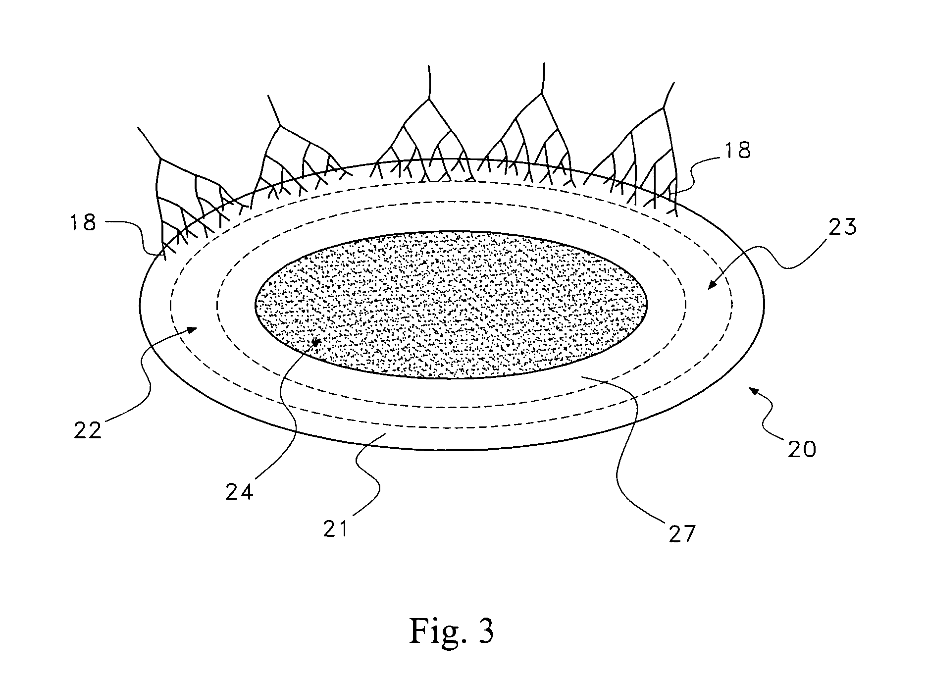 Pharmaceutical removal of vascular extensions from a degenerating disc