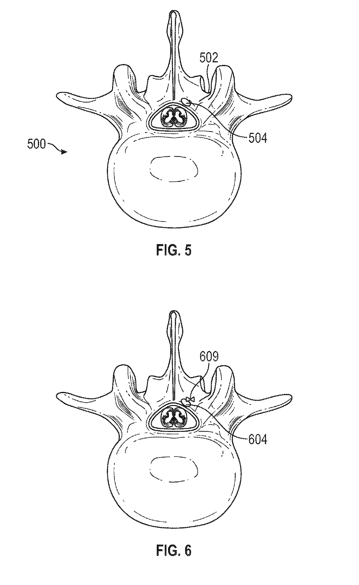 Shape Memory Surgical Sponge For Retracting The Dura During A Laminectomy Procedure