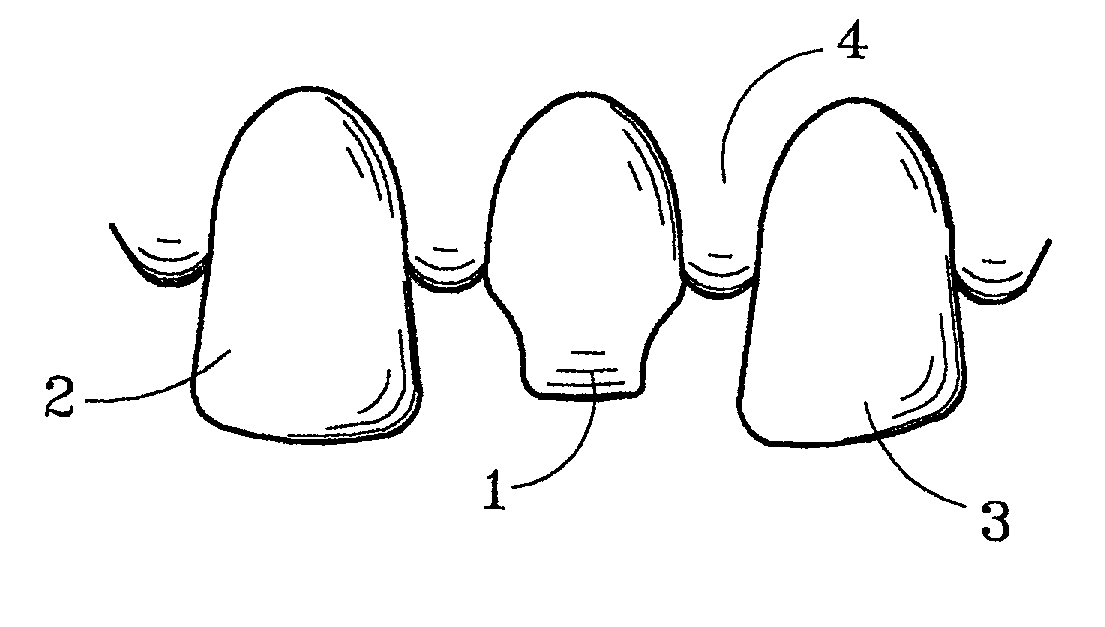 Material for forming porcelain tooth restorations