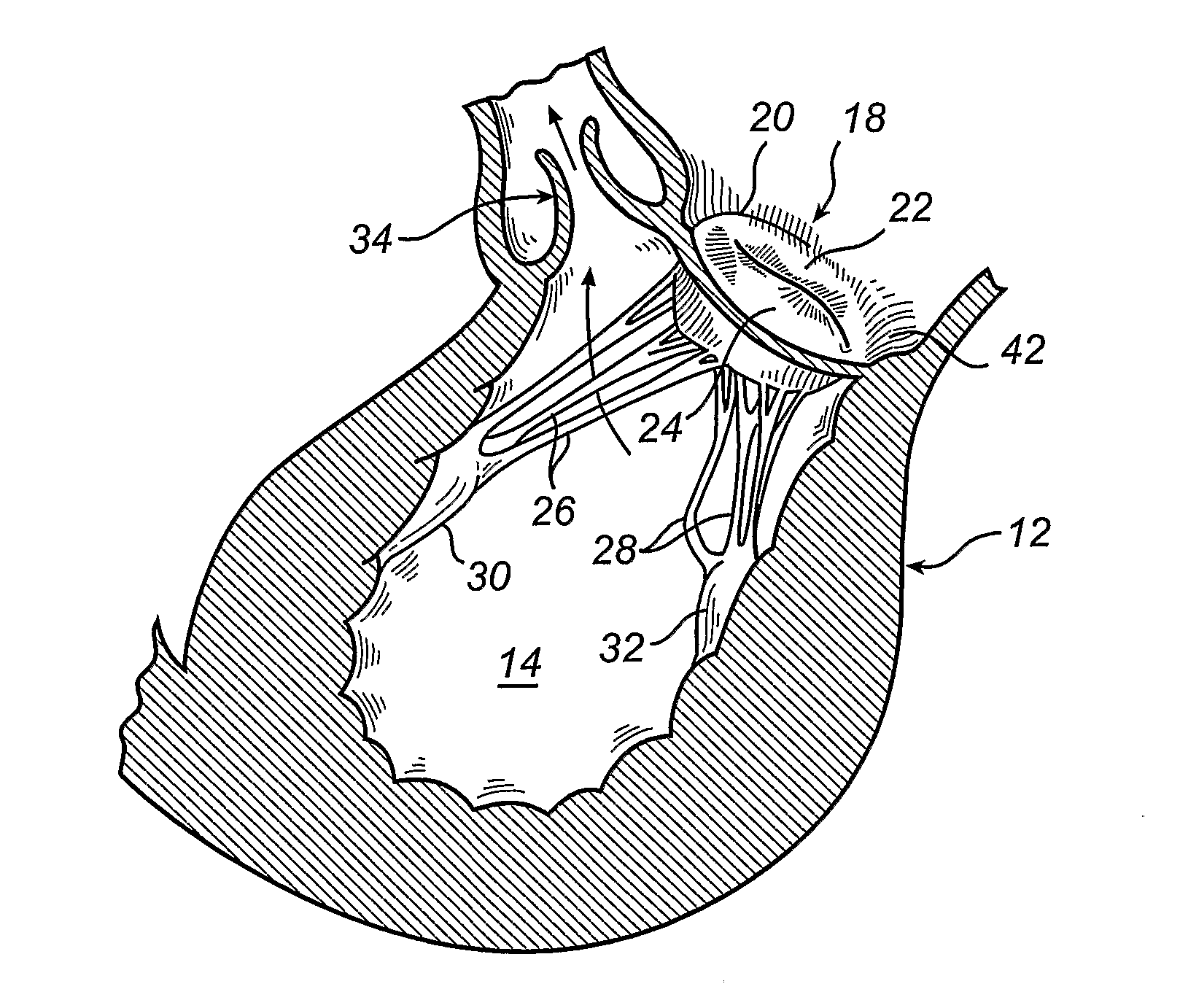 Devices and a Kit for Improving the Function of a Heart Valve