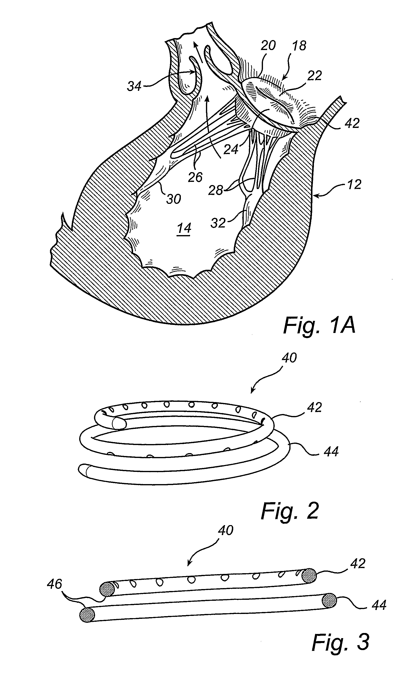 Devices and a Kit for Improving the Function of a Heart Valve