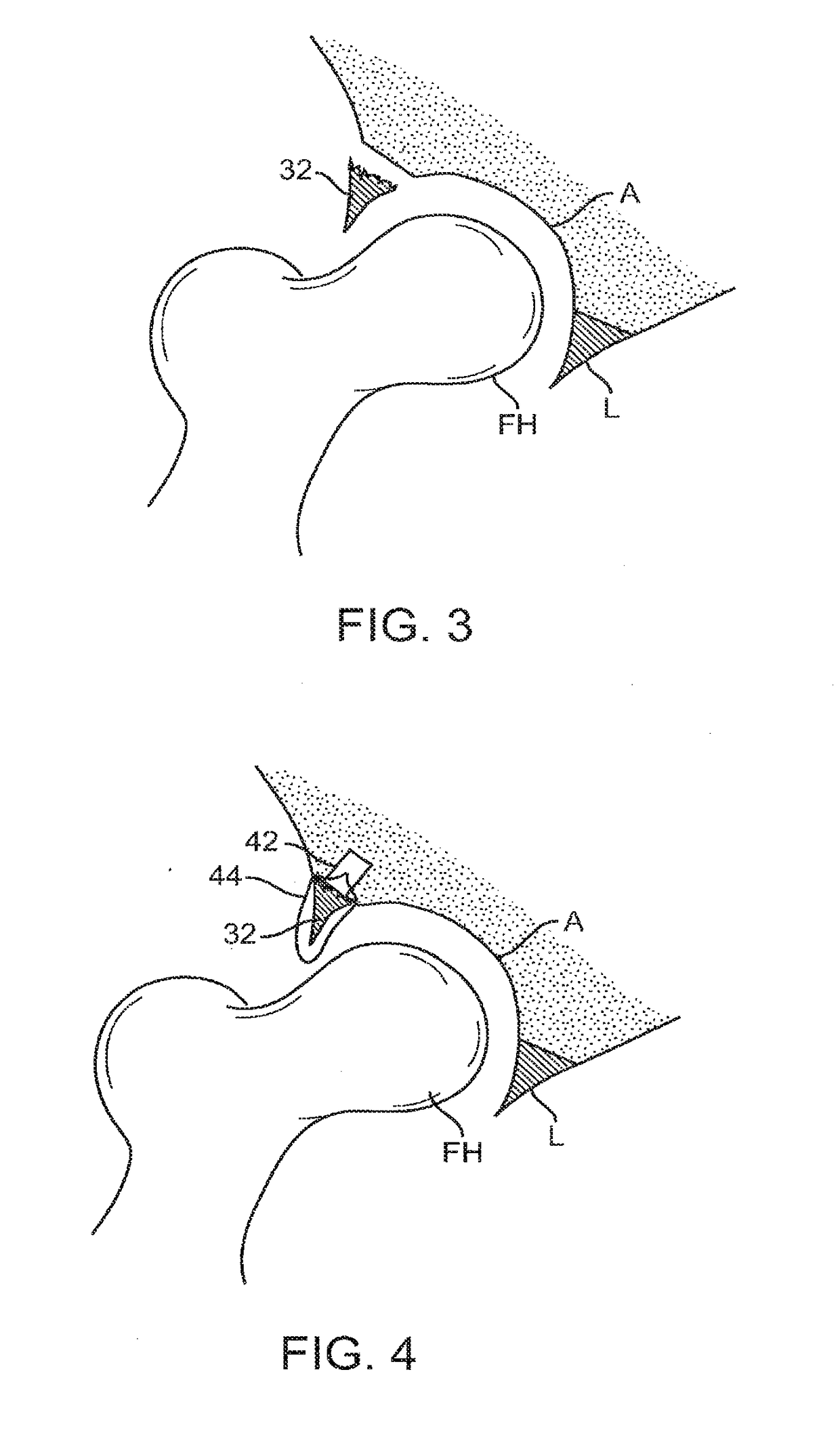 Knotless suture anchor and methods of use