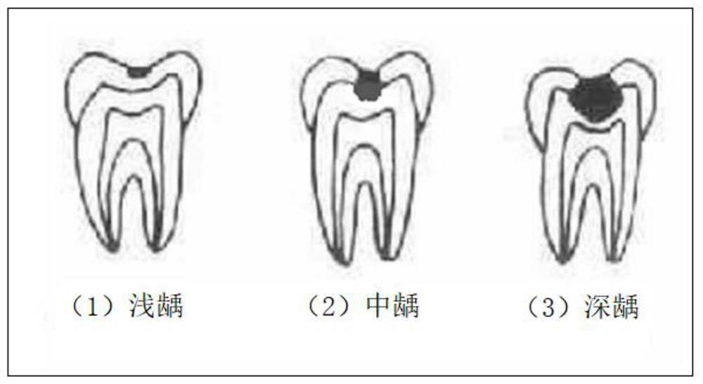 Oral panoramic film decayed tooth depth recognition method based on deep learning