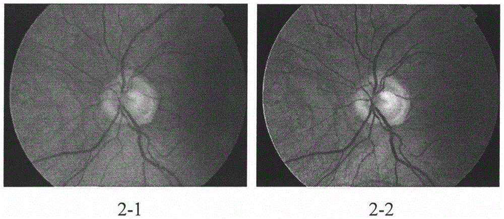Automatic detection method for microaneurysm in color eye fundus image