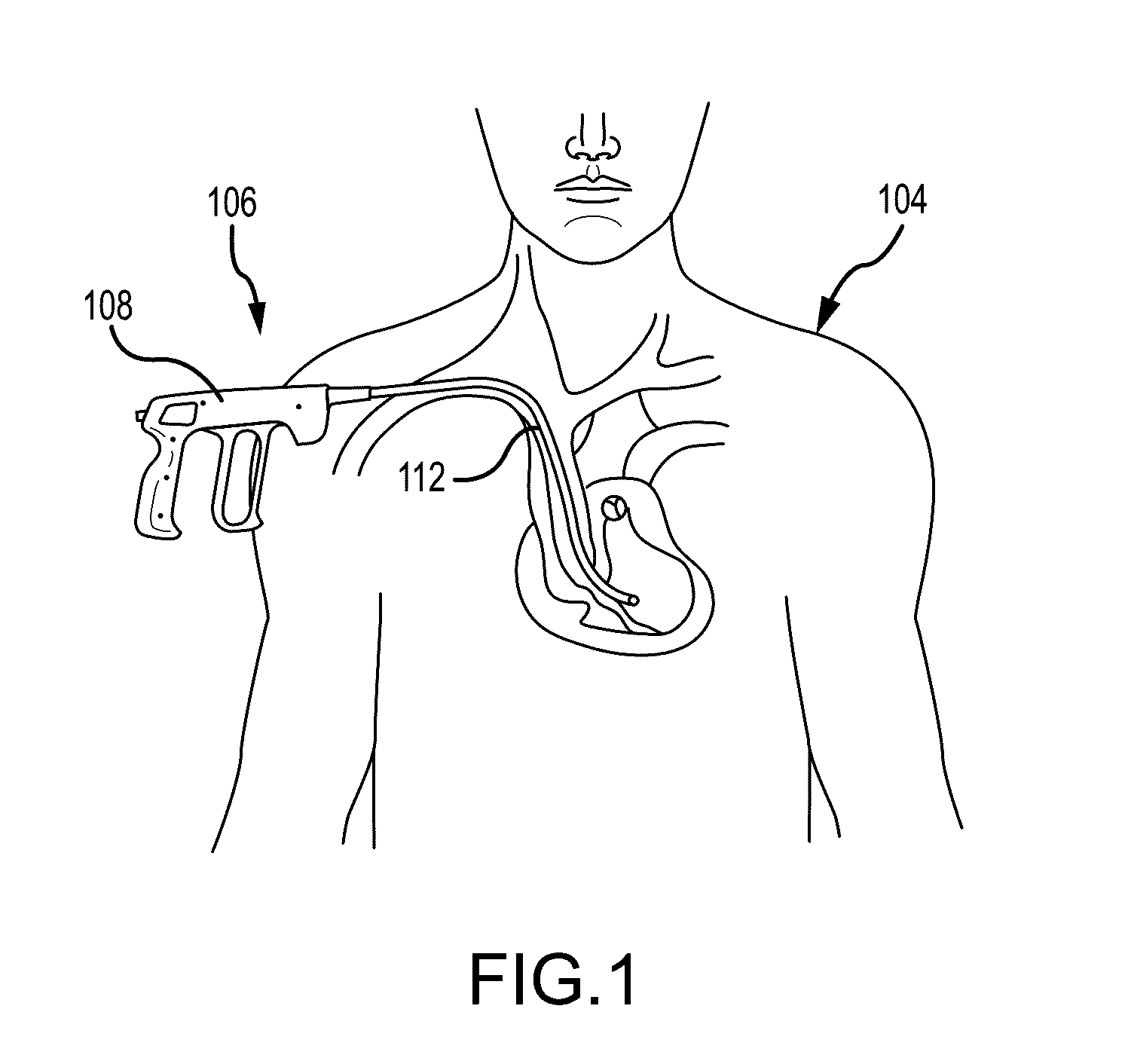Medical device for removing an implanted object using laser cut hypotubes