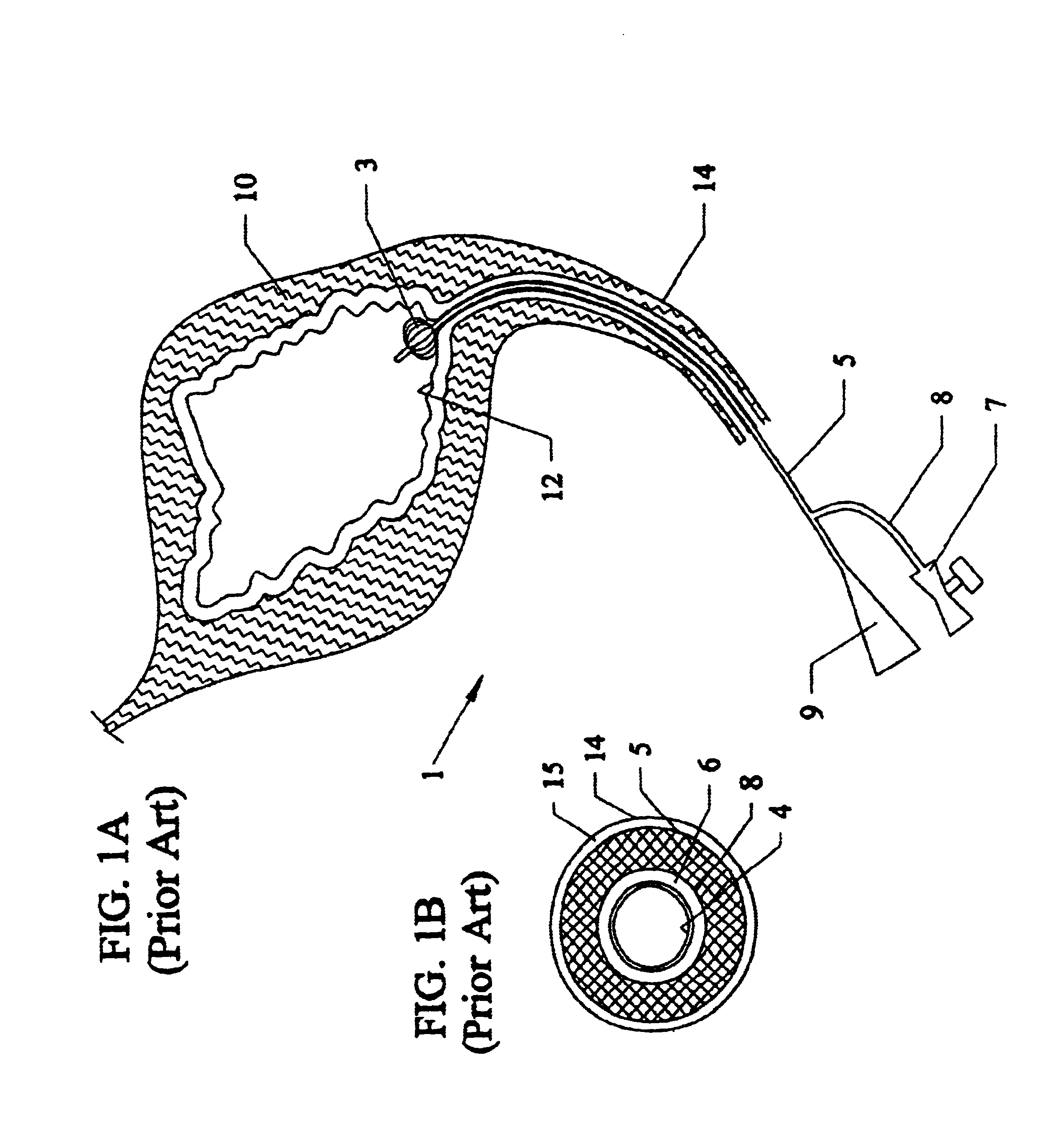 Conformable balloonless catheter