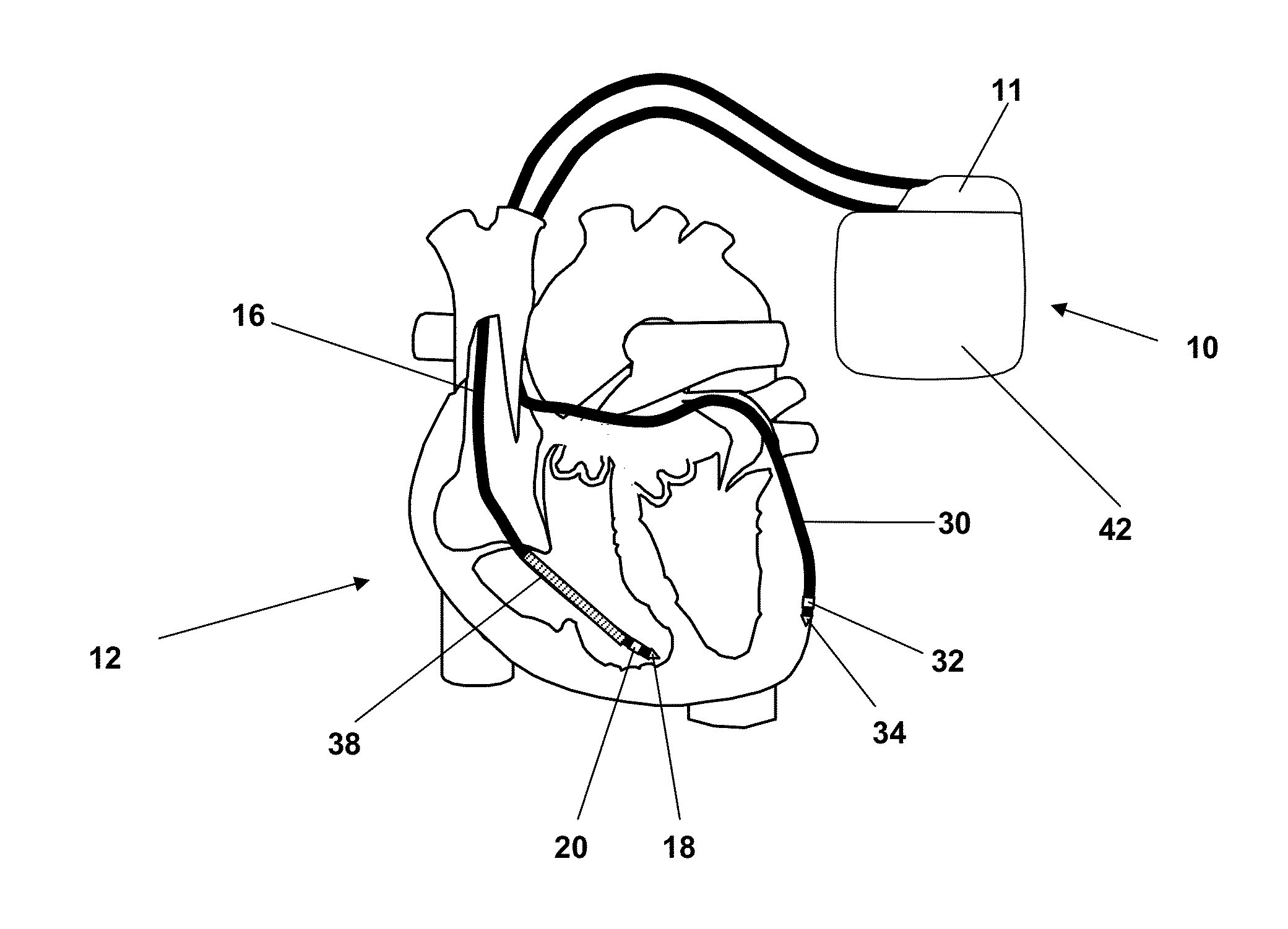 Heart therapy device for detecting ventricular tachycardia and fibrillation