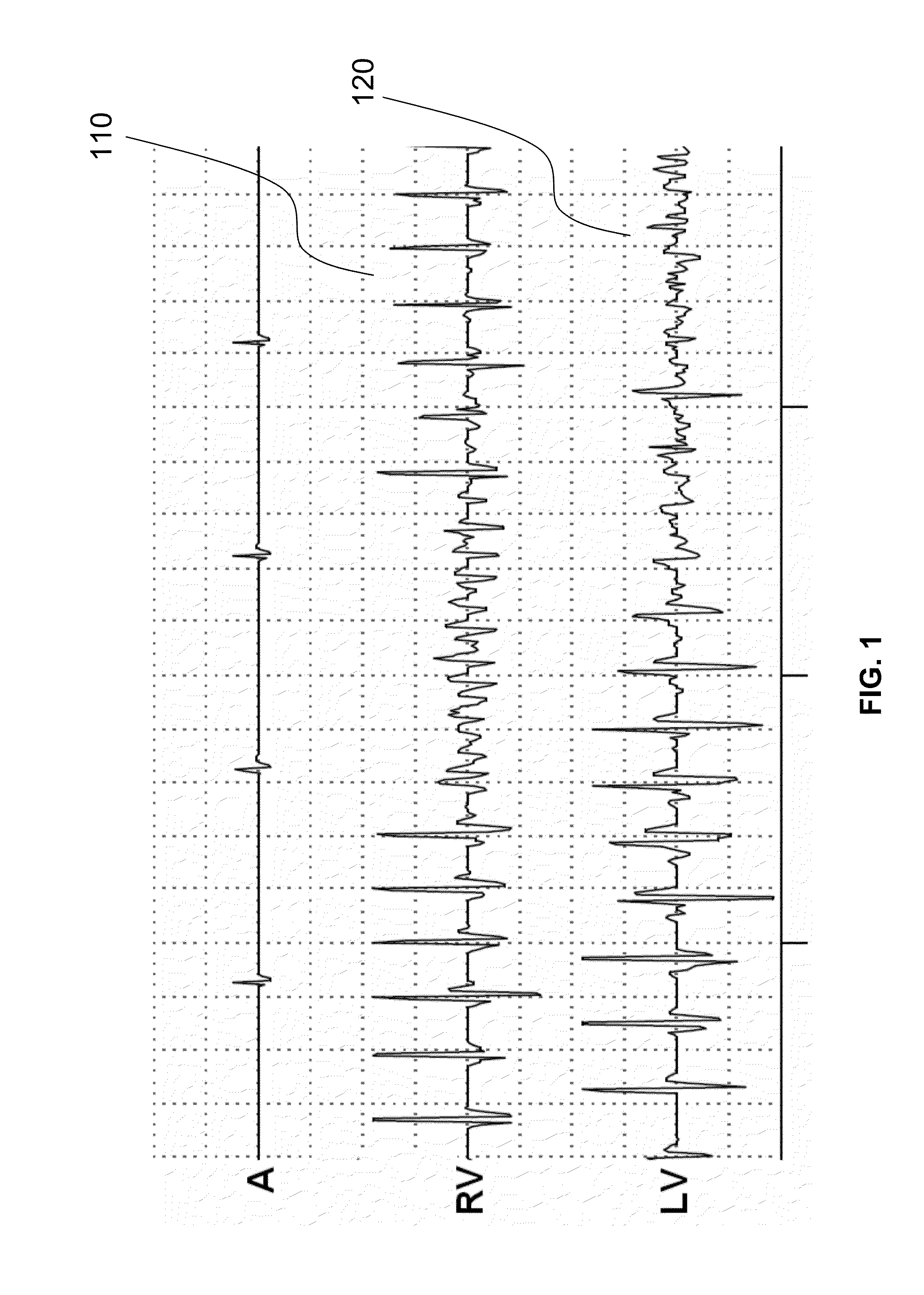 Heart therapy device for detecting ventricular tachycardia and fibrillation