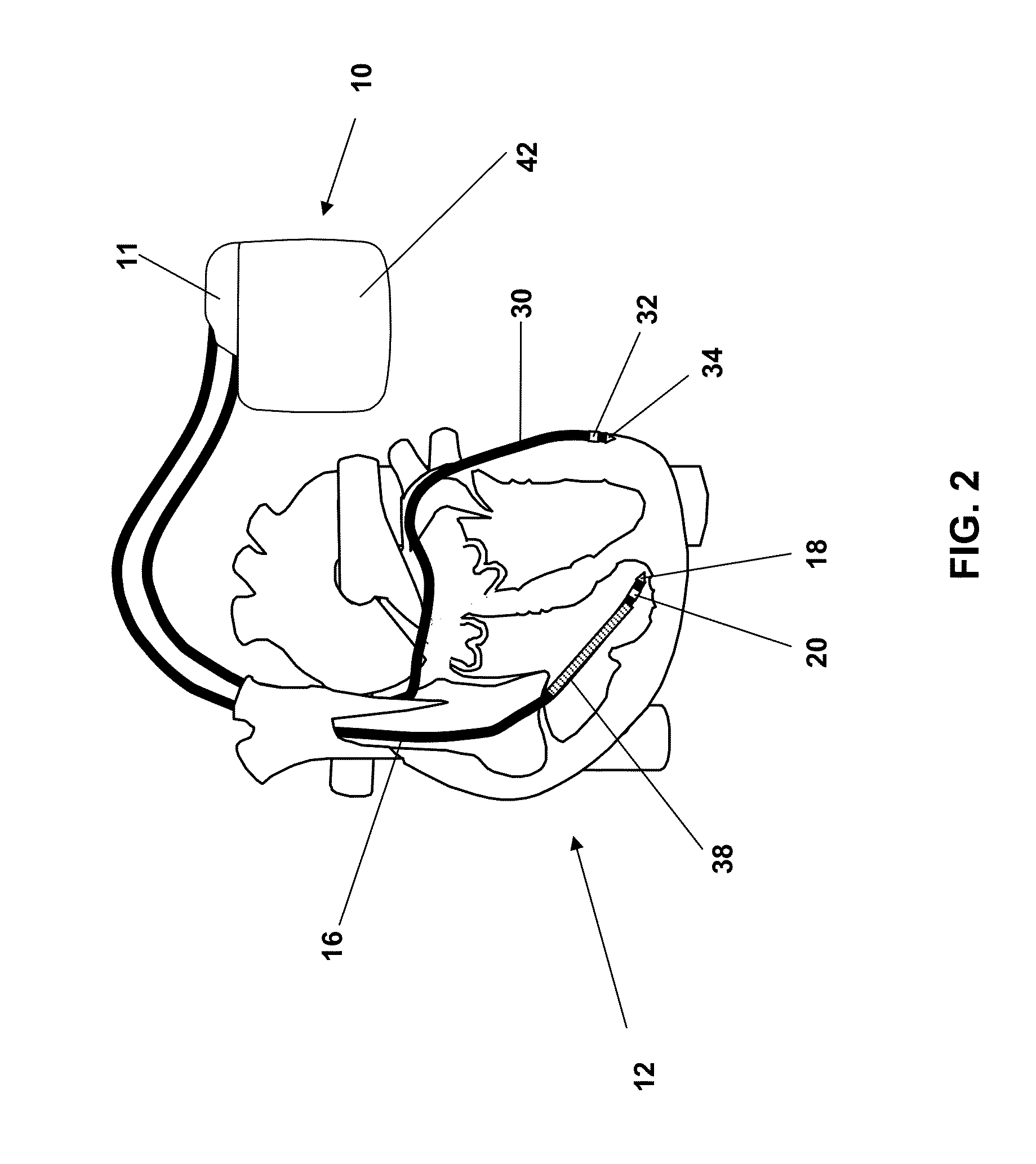 Heart therapy device for detecting ventricular tachycardia and fibrillation