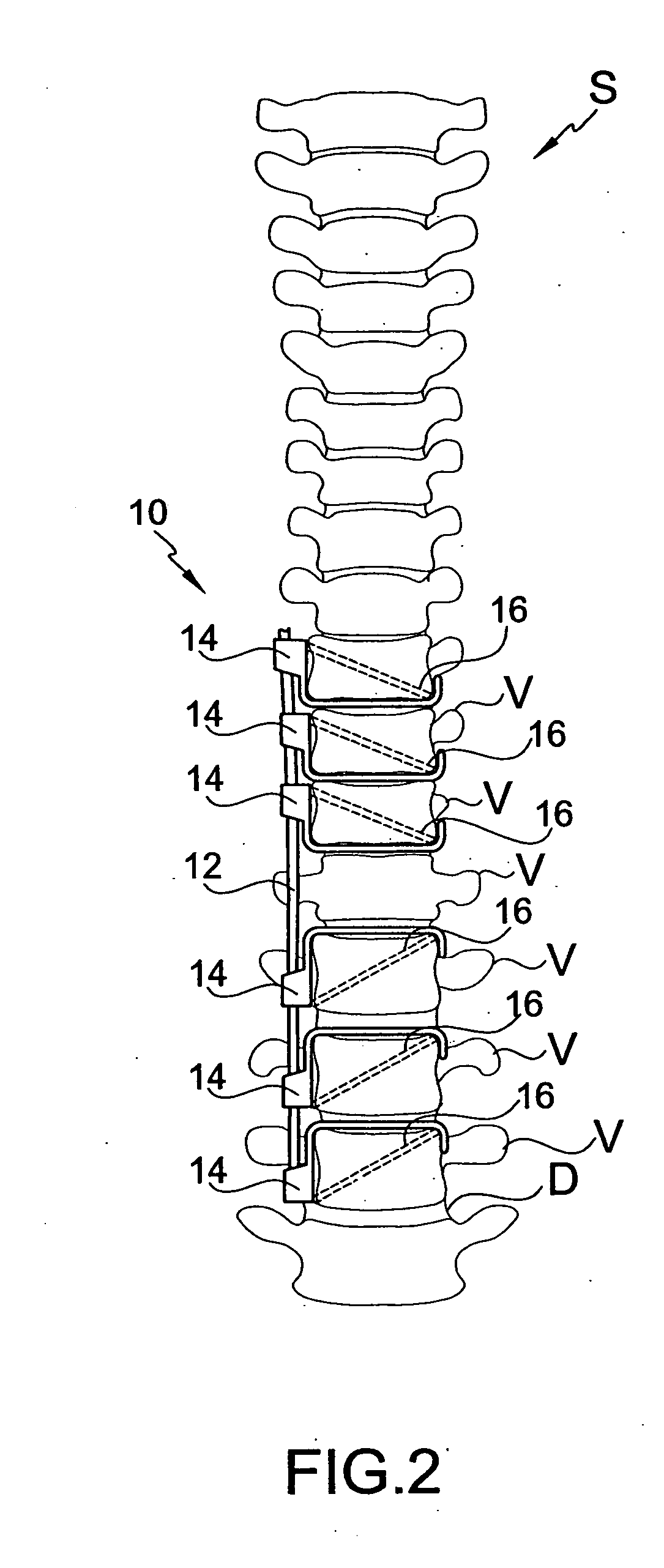 Connector for attaching an alignment rod to a bone structure