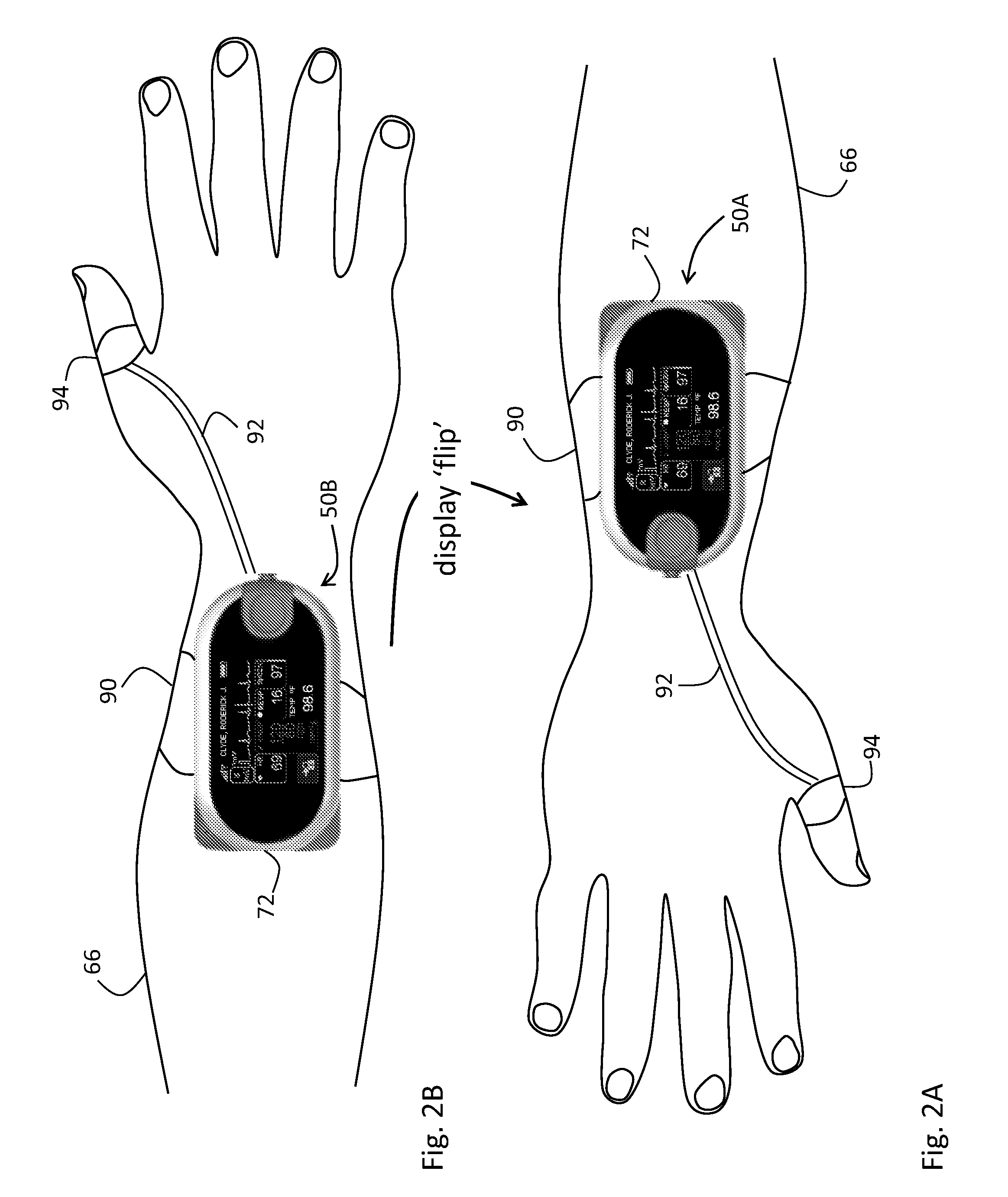 Body-worn vital sign monitor
