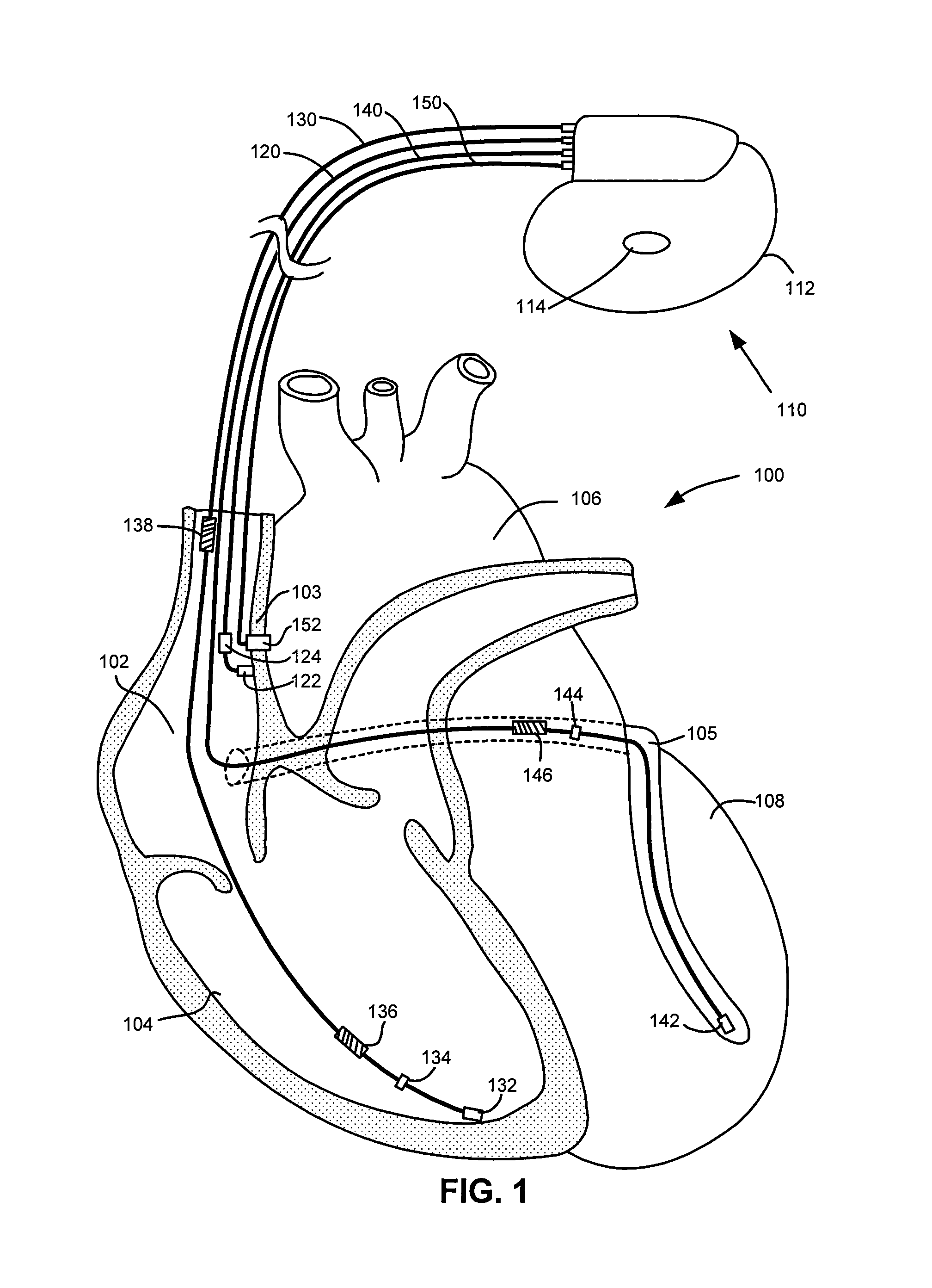 Implantable cardiac device and method for monitoring blood-glucose concentration