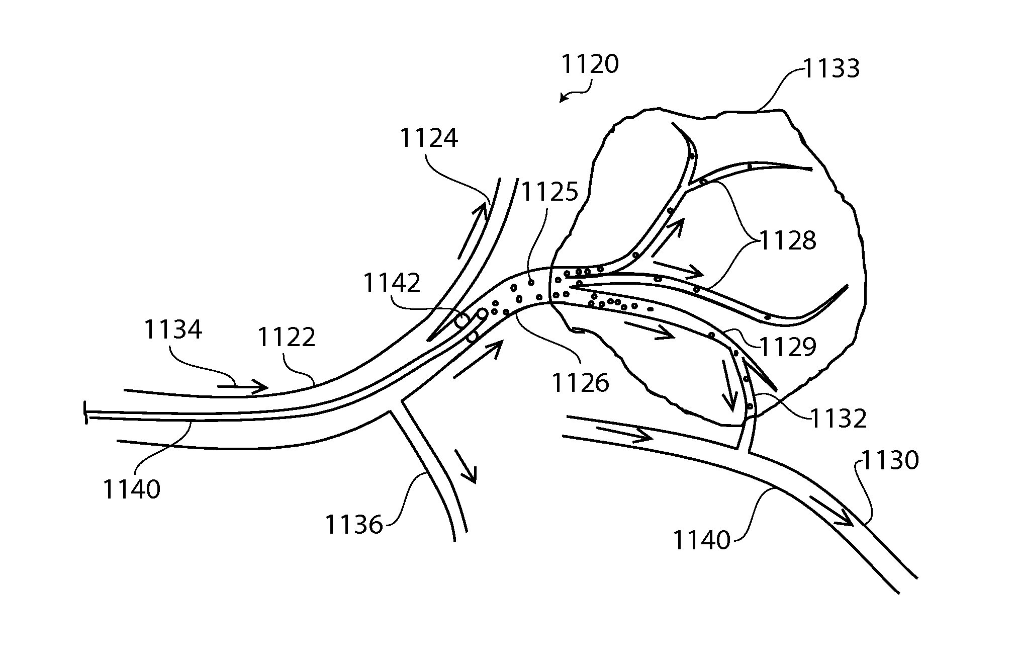 Device and methods for transvascular tumor embolization with integrated flow regulation