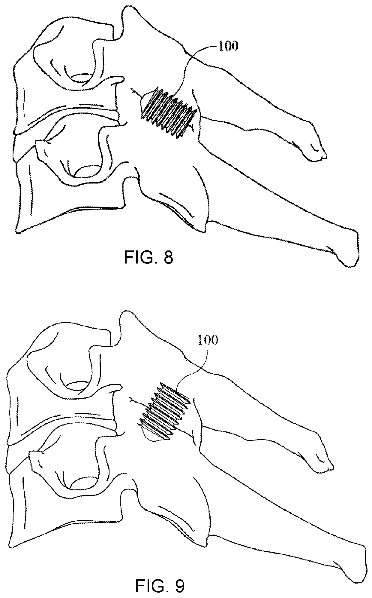 Screw bone implant