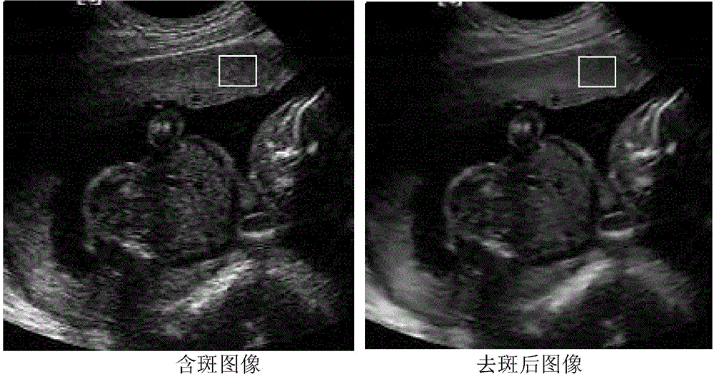 Medical ultrasound image speckle removing method through quantum inspiration