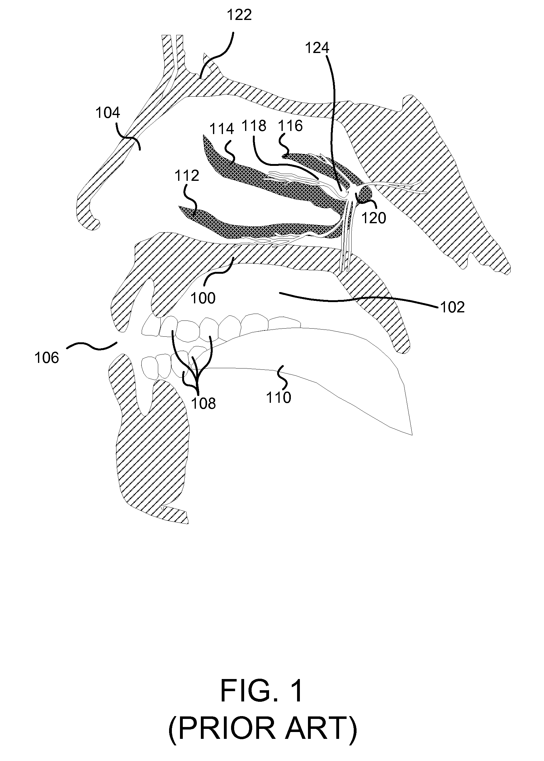 Apparatus, System, and Method for Treating Atypical Headaches