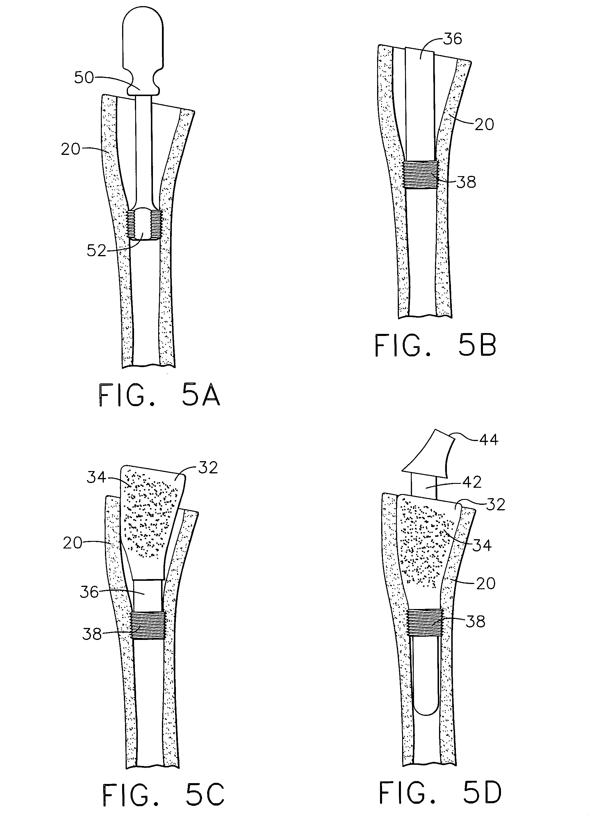 Bone cell covered arthroplasty devices