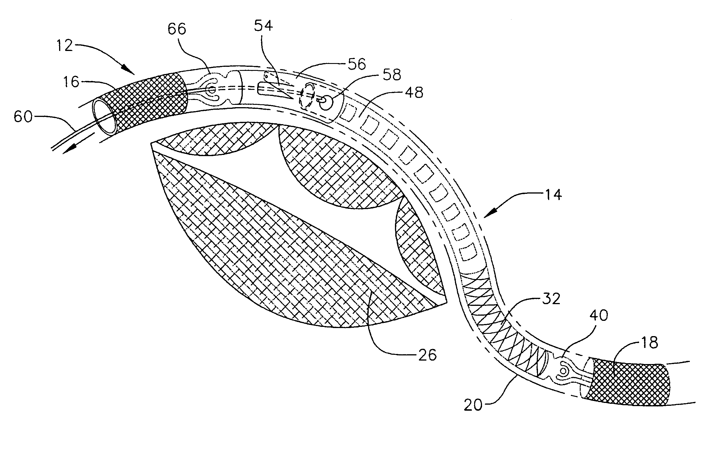 Devices and methods for percutaneous repair of the mitral valve via the coronary sinus