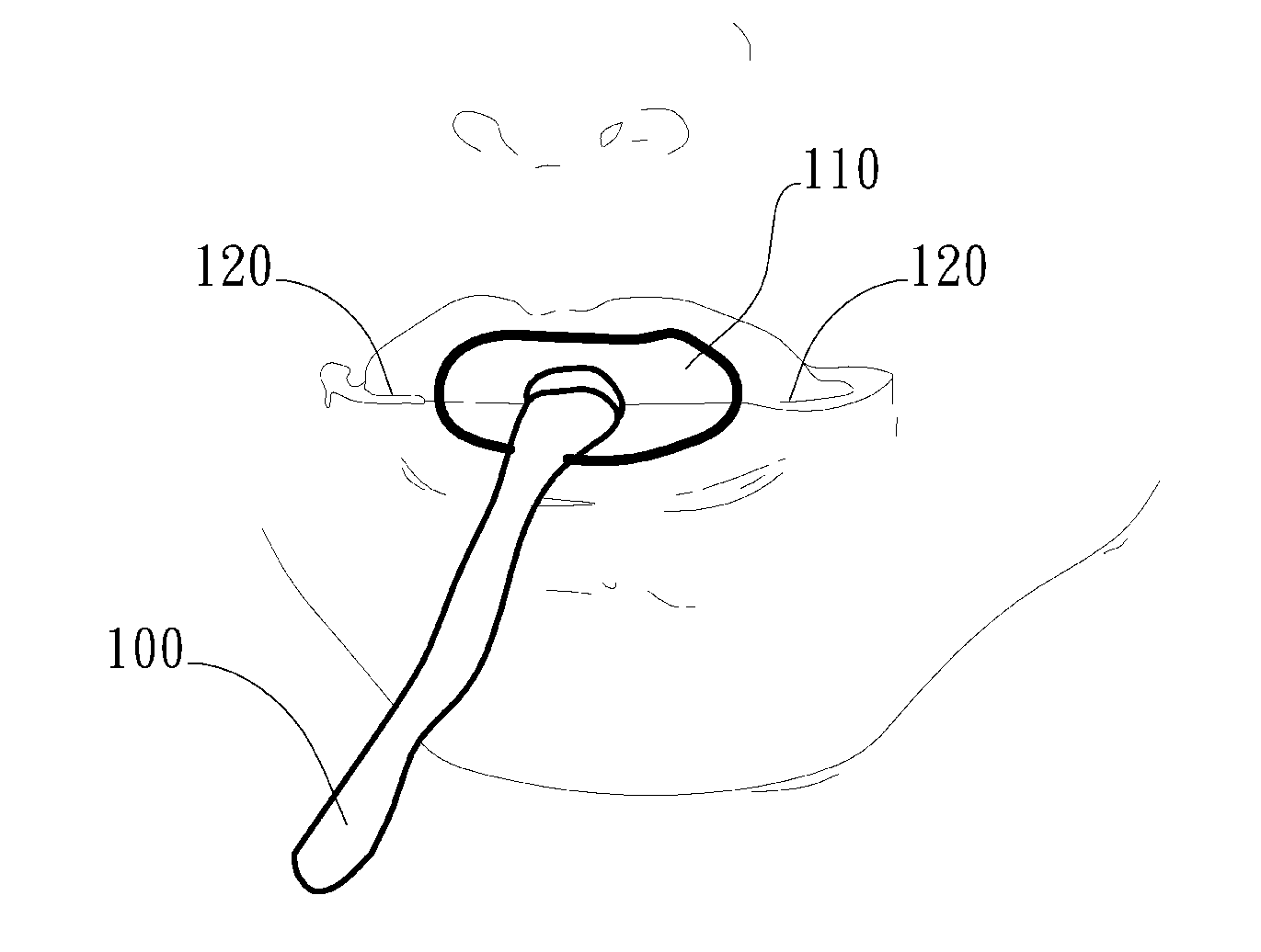 Adjustable oral interface and method to maintain upper airway patency