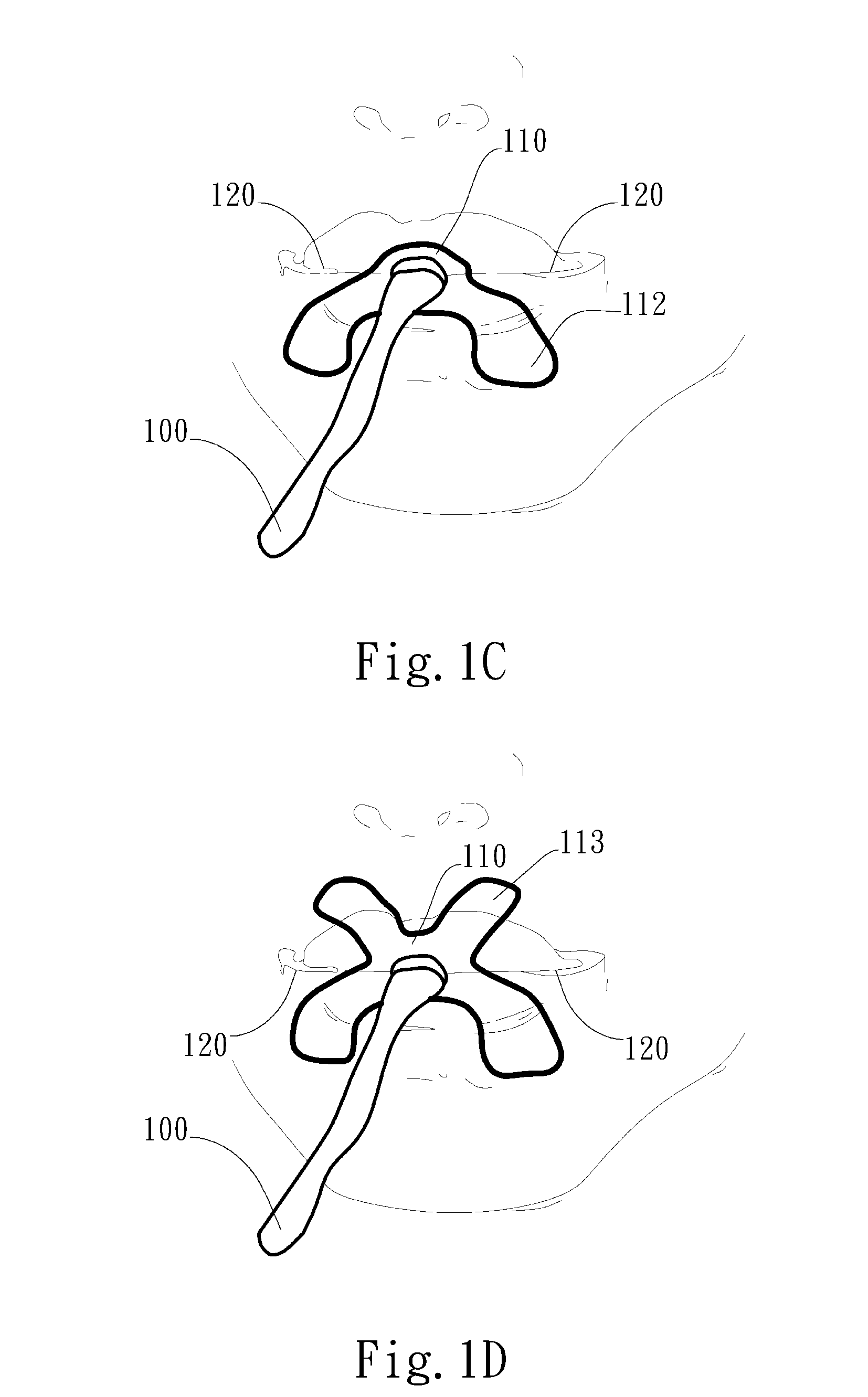 Adjustable oral interface and method to maintain upper airway patency