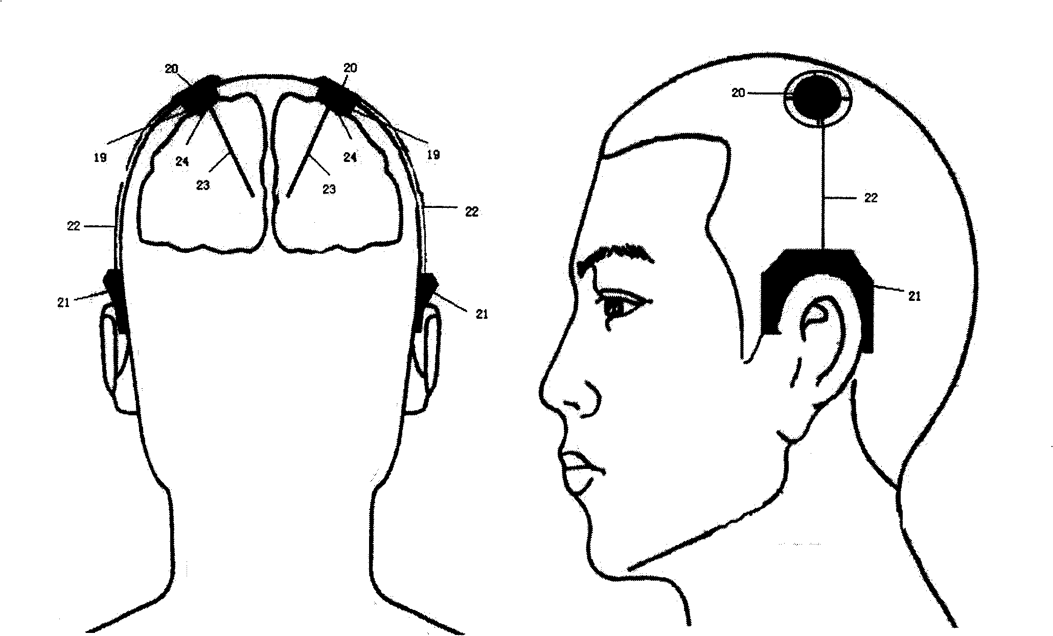 Intelligent cranial nuclei electric stimulation system