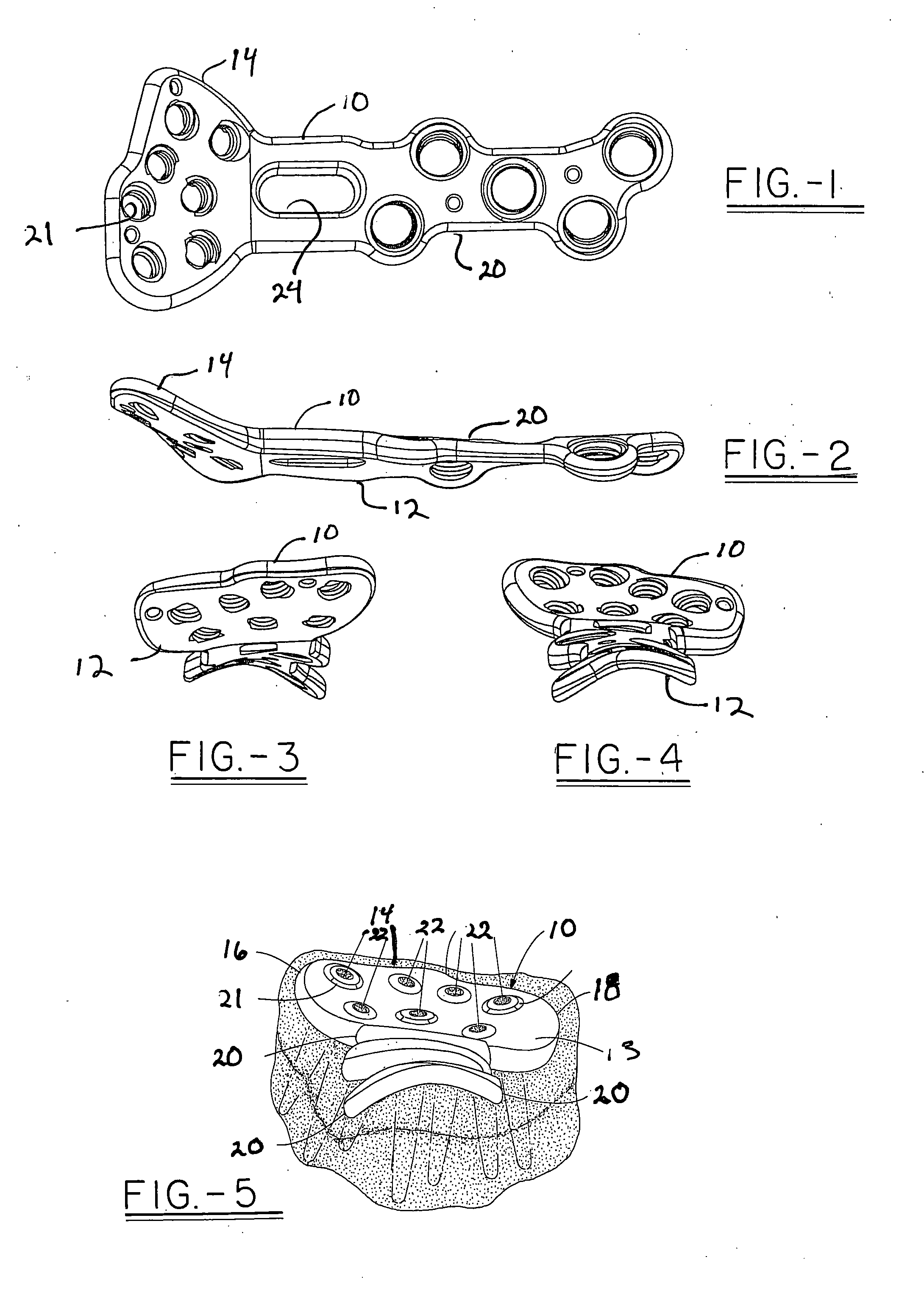 Method of designing orthopedic plates and plates made in accordance with the method