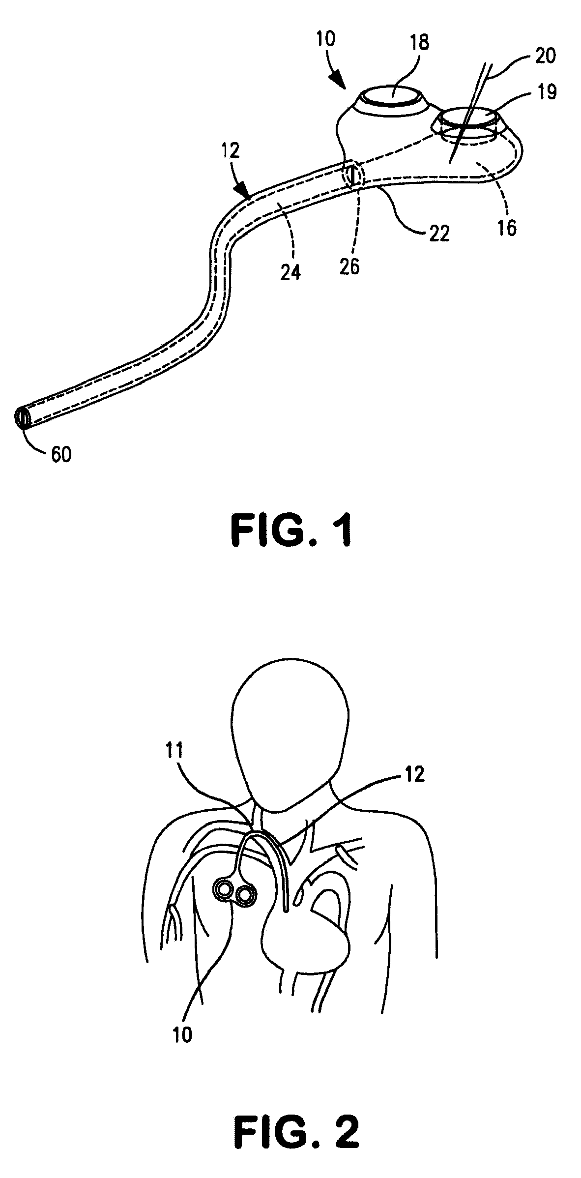 Implantable catheter port
