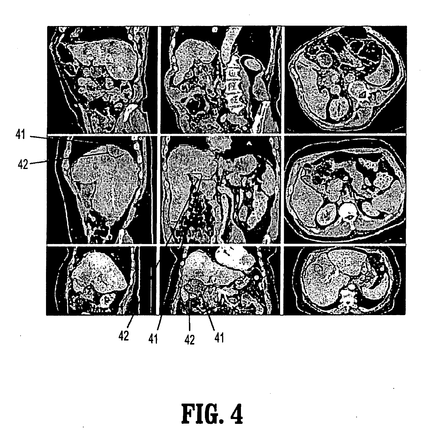 System and method for global-to-local shape matching for automatic liver segmentation in medical imaging