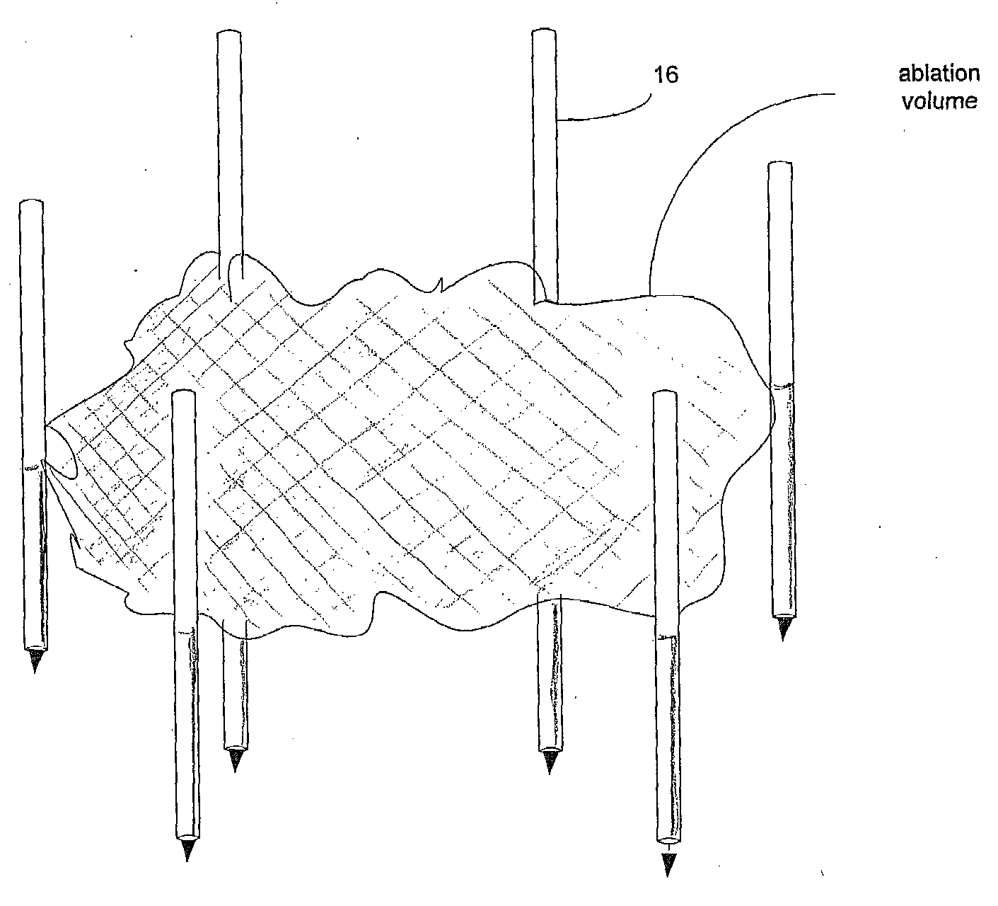 Methods and Systems for Treating BPH Using Electroporation