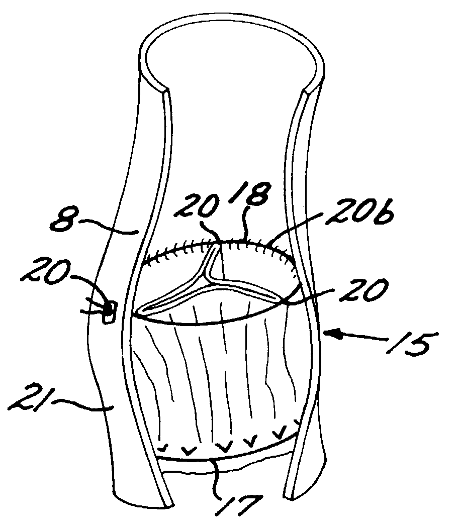 Reed valve for implantation into mammalian blood vessels and heart with optional temporary or permanent support
