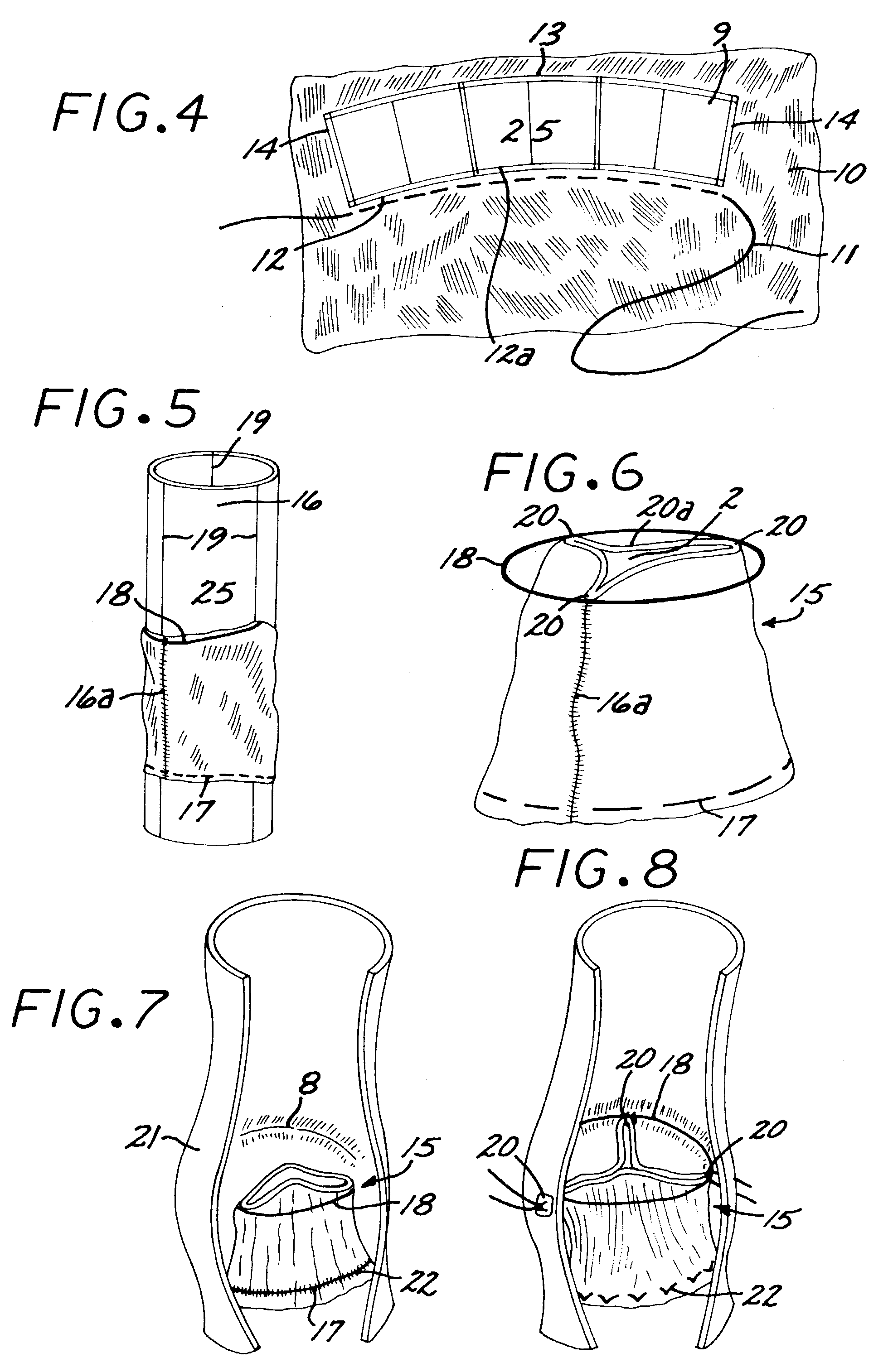 Reed valve for implantation into mammalian blood vessels and heart with optional temporary or permanent support
