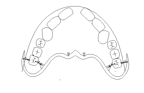 Molar intrusion apparatus