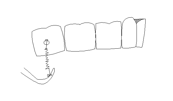 Molar intrusion apparatus